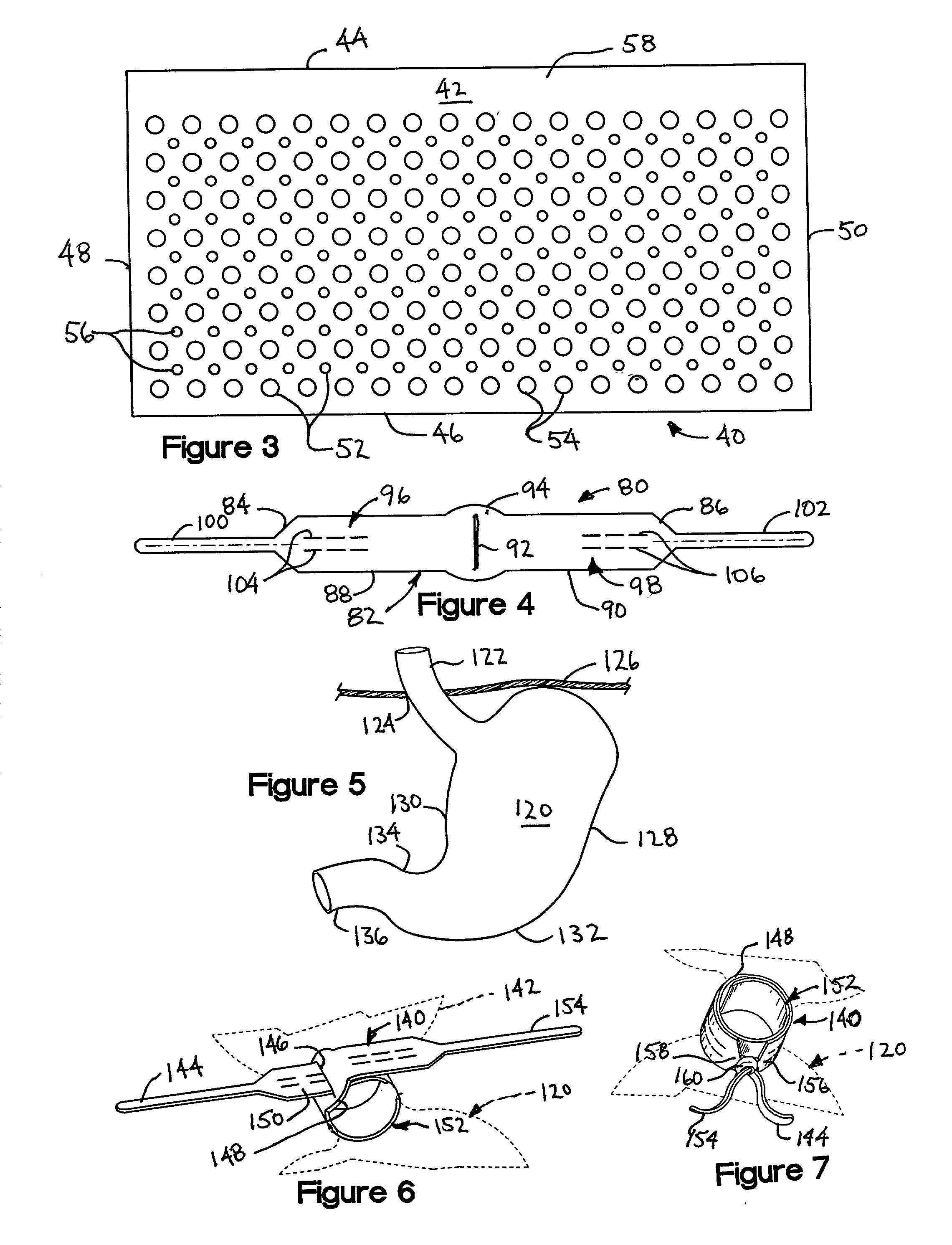 System to inhibit and/or control expansion of anatomical features