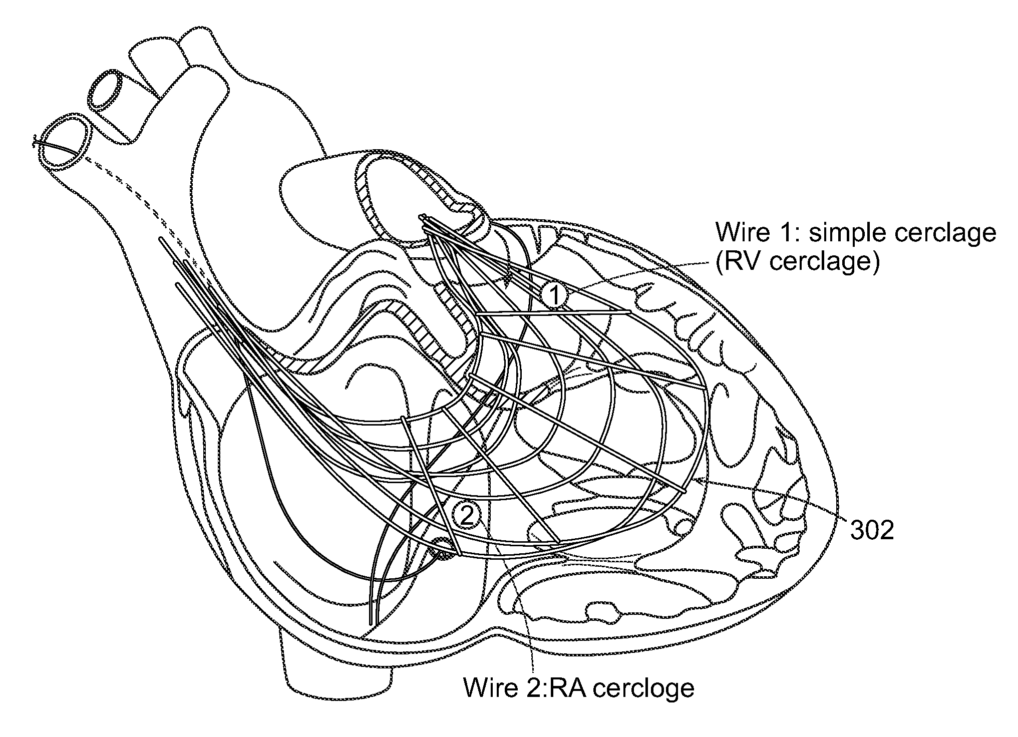 Methods and devices for transcatheter cerclage annuloplasty