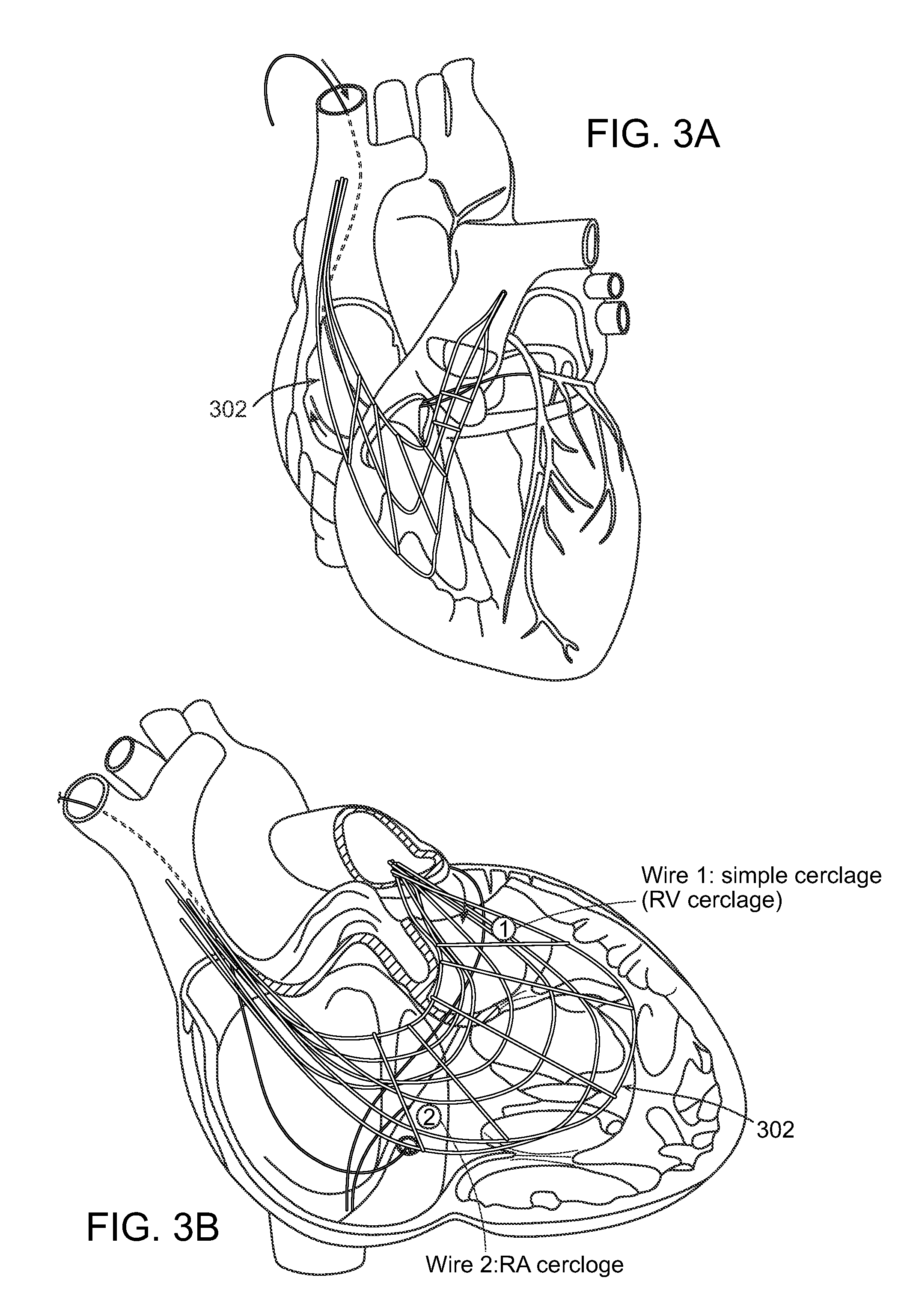 Methods and devices for transcatheter cerclage annuloplasty