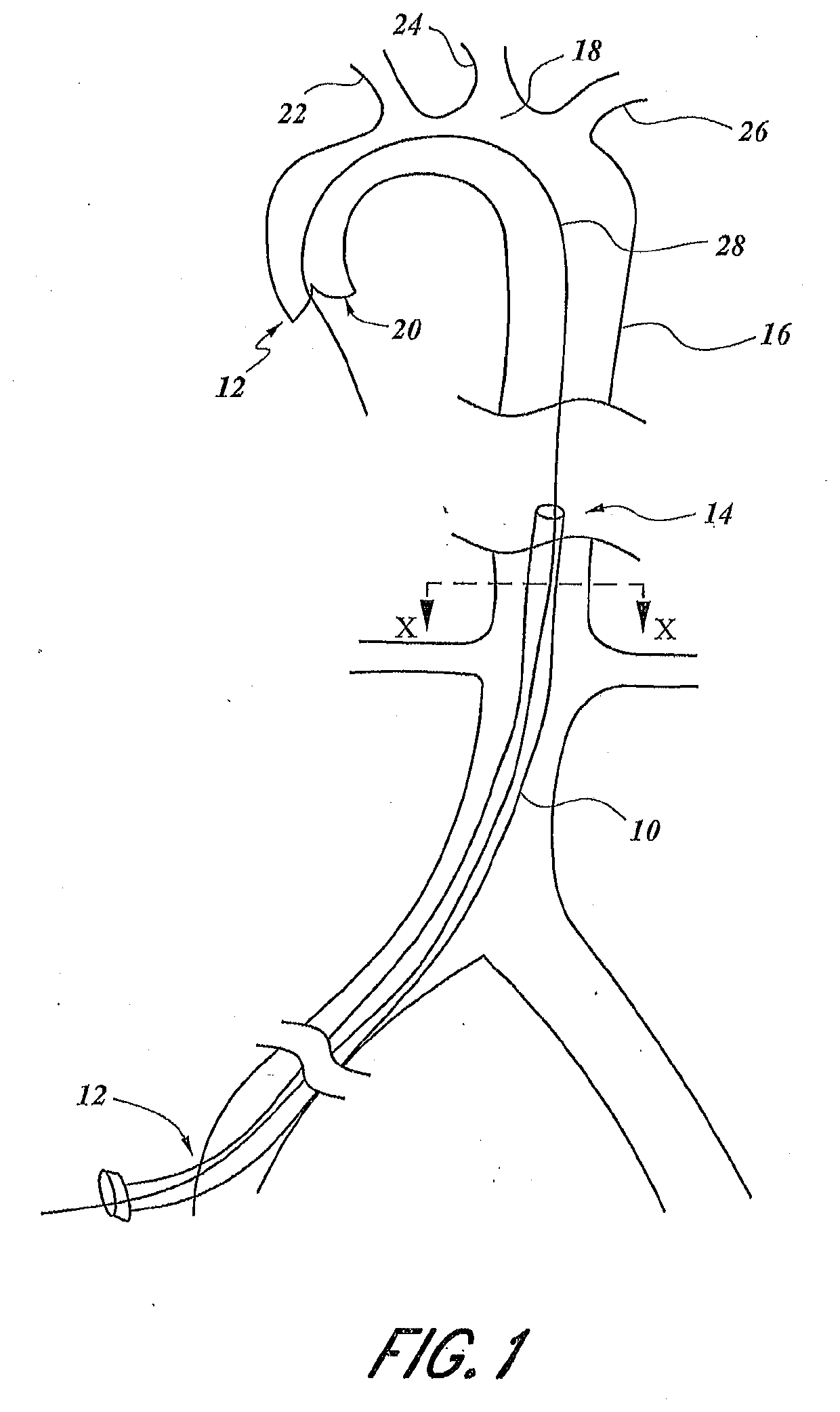 Embolic protection access system