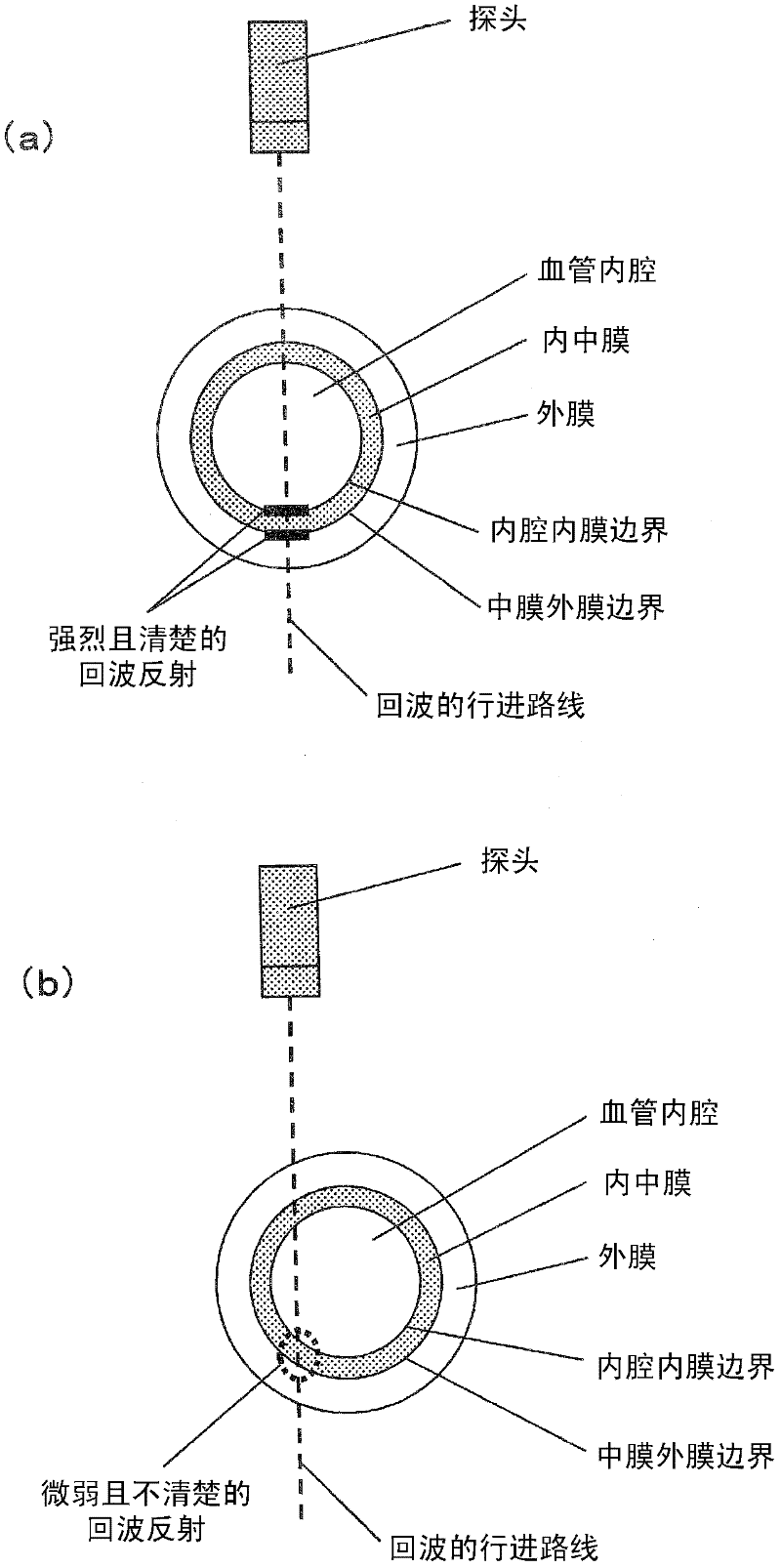 Ultrasonic diagnostic device, and method for measuring intima-media complex thickness