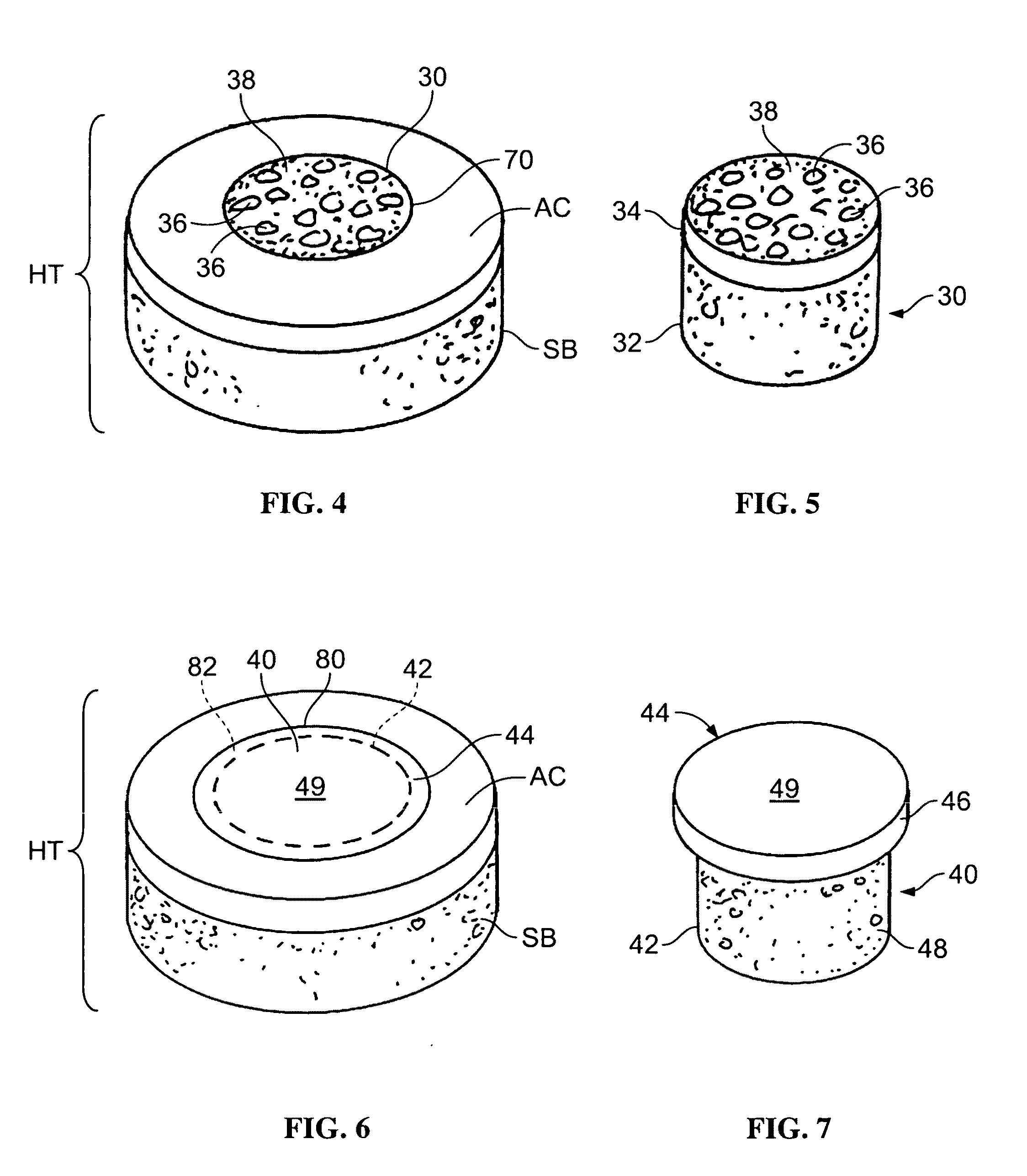 Allograft osteochondral plug combined with cartilage particle mixture