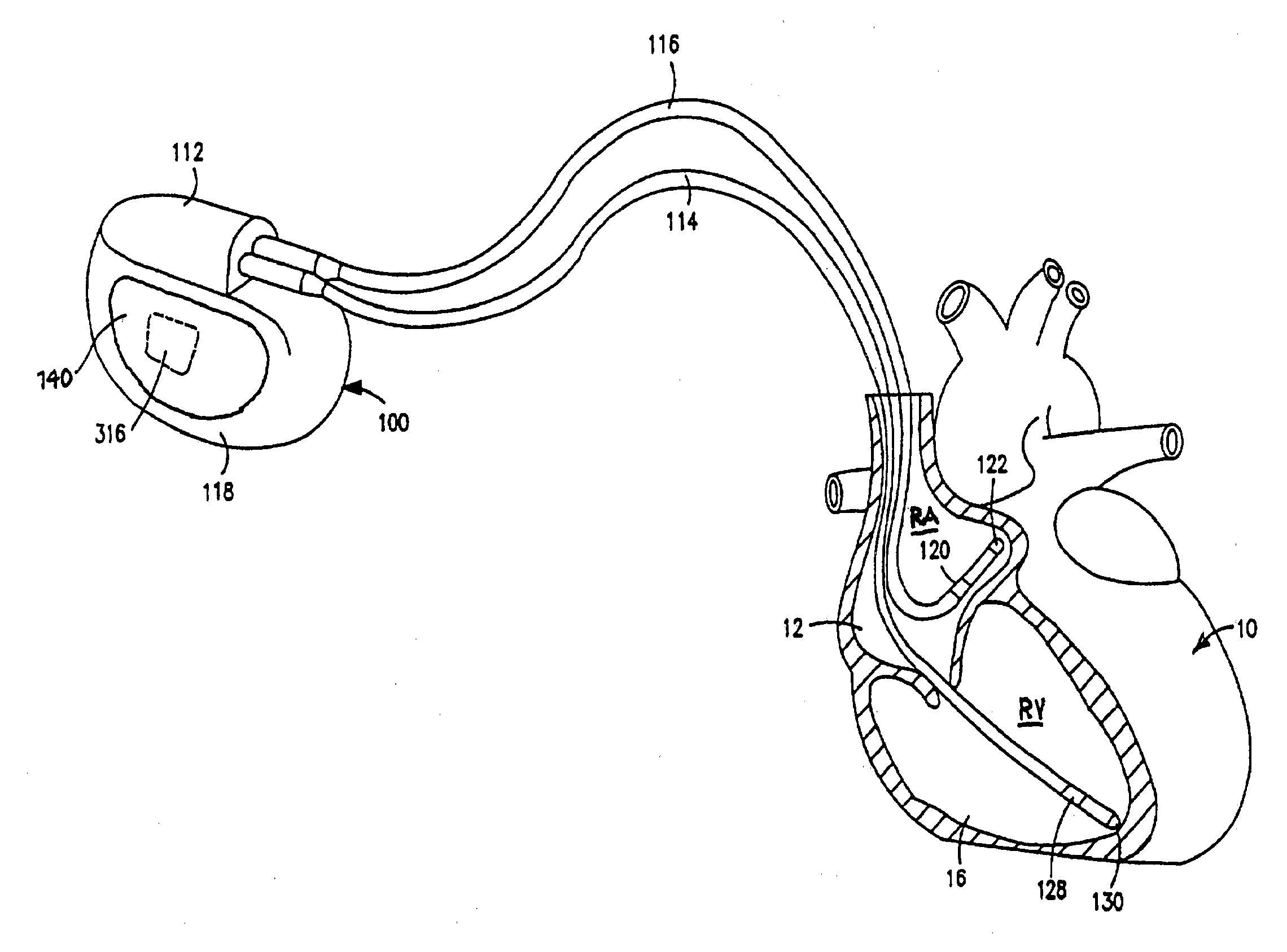 Methods and apparatus for detecting ventricular depolarizations during atrial pacing