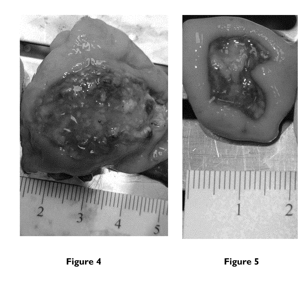Bimodal treatment methods and compositions for gastrointestinal lesions with active bleeding
