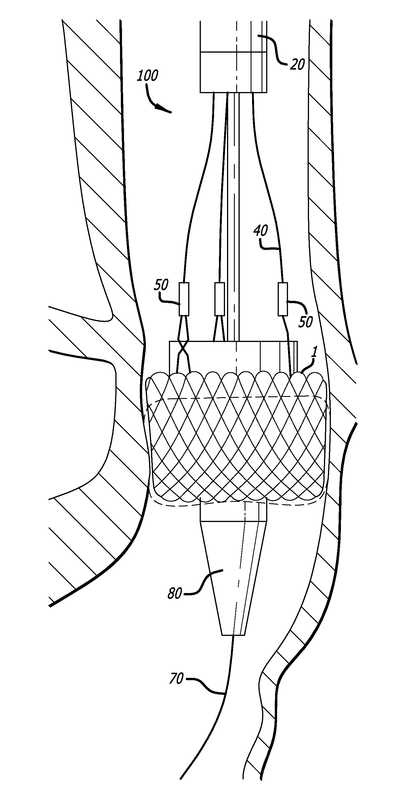 Inversion Delivery Device and Method For A Prosthesis