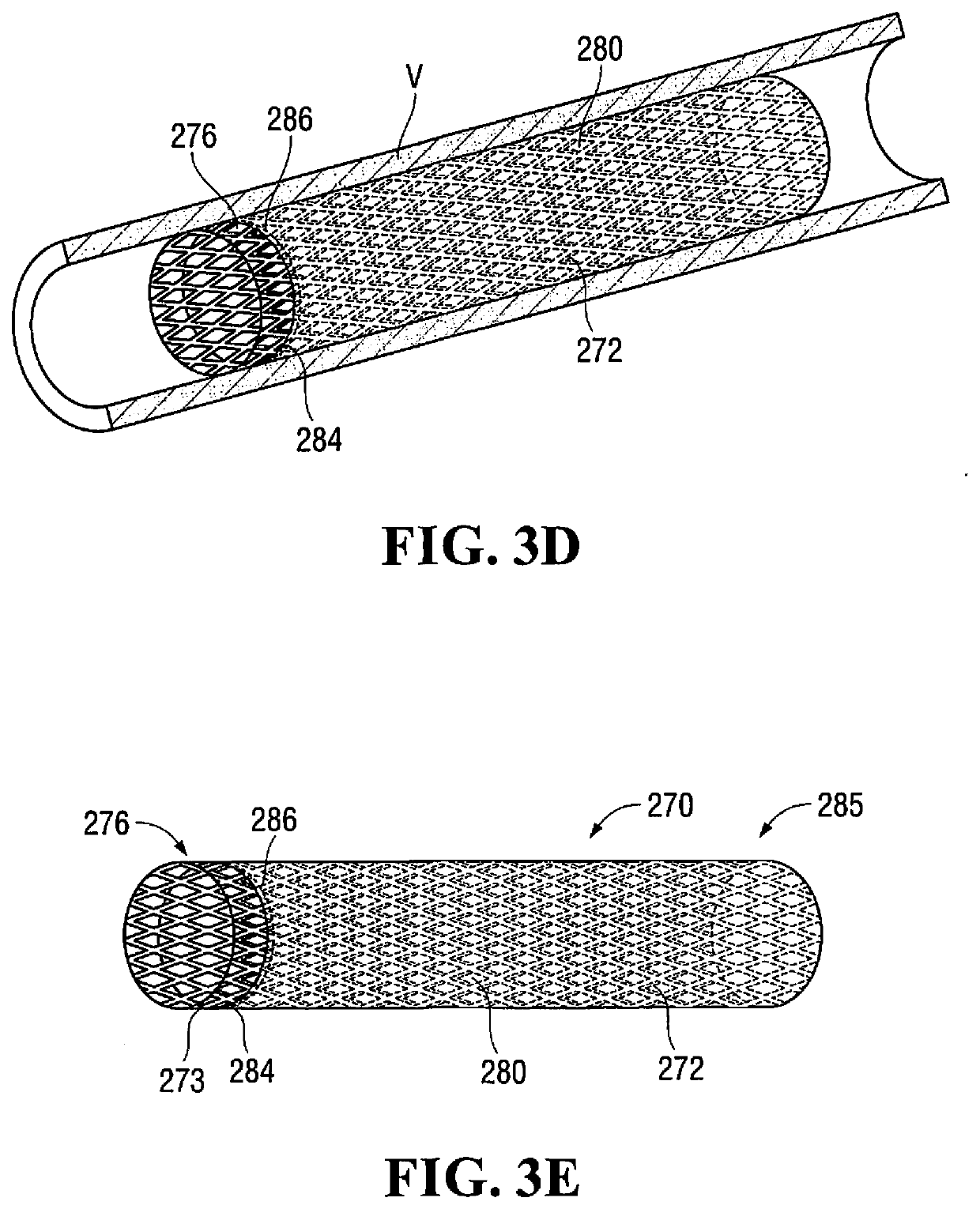 Caped stent