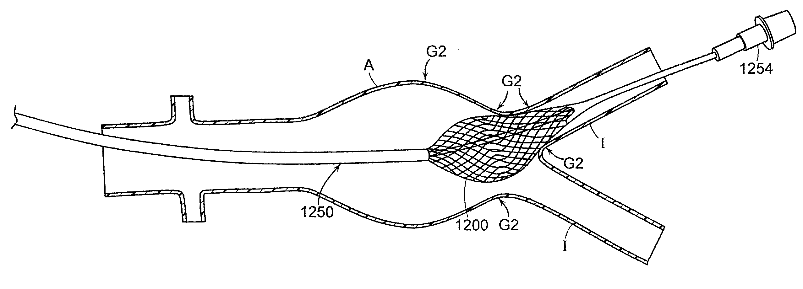 Non-occluding dilation device