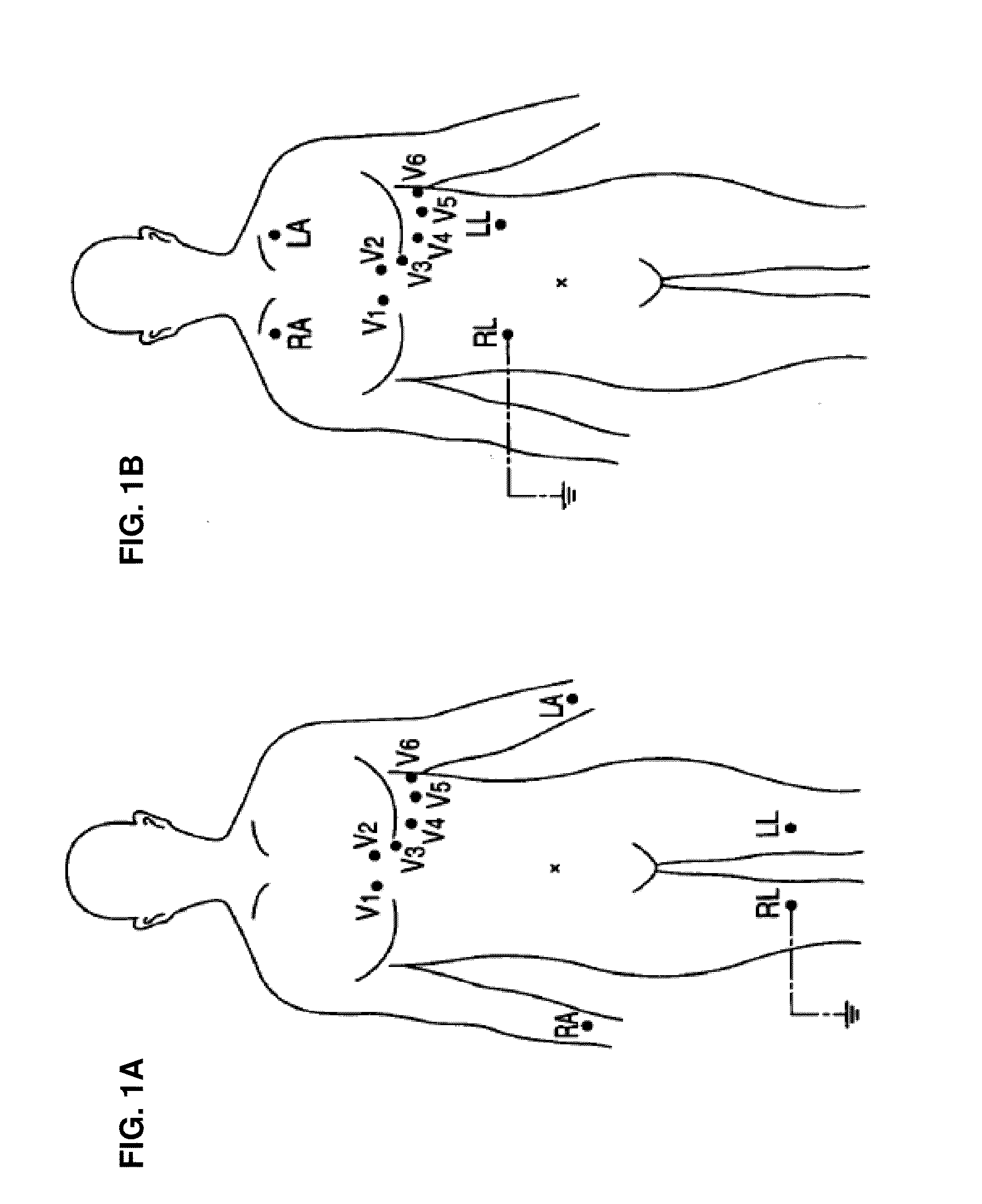 Device for mobile electrocardiogram recording