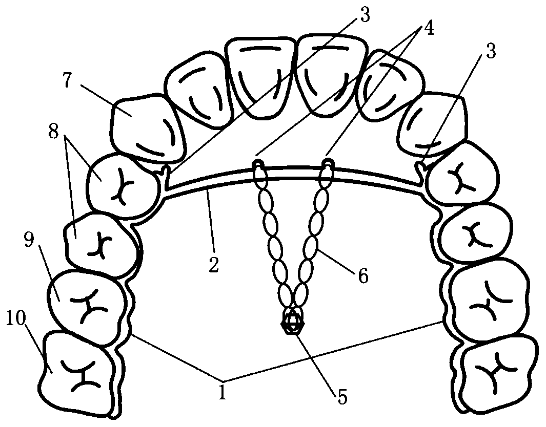 One-piece molar-back-pushing device
