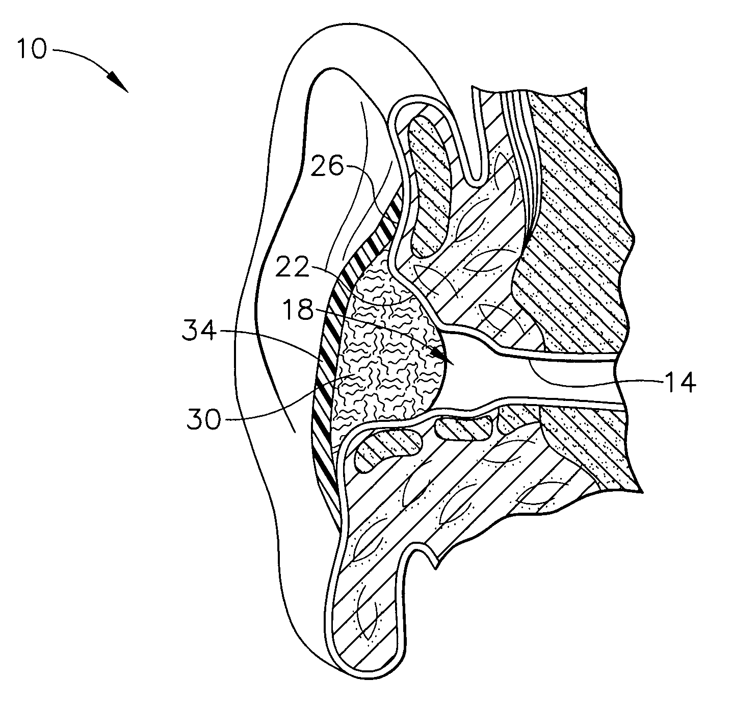 Method for forming occlusive barrier over ear canal and kit for providing same