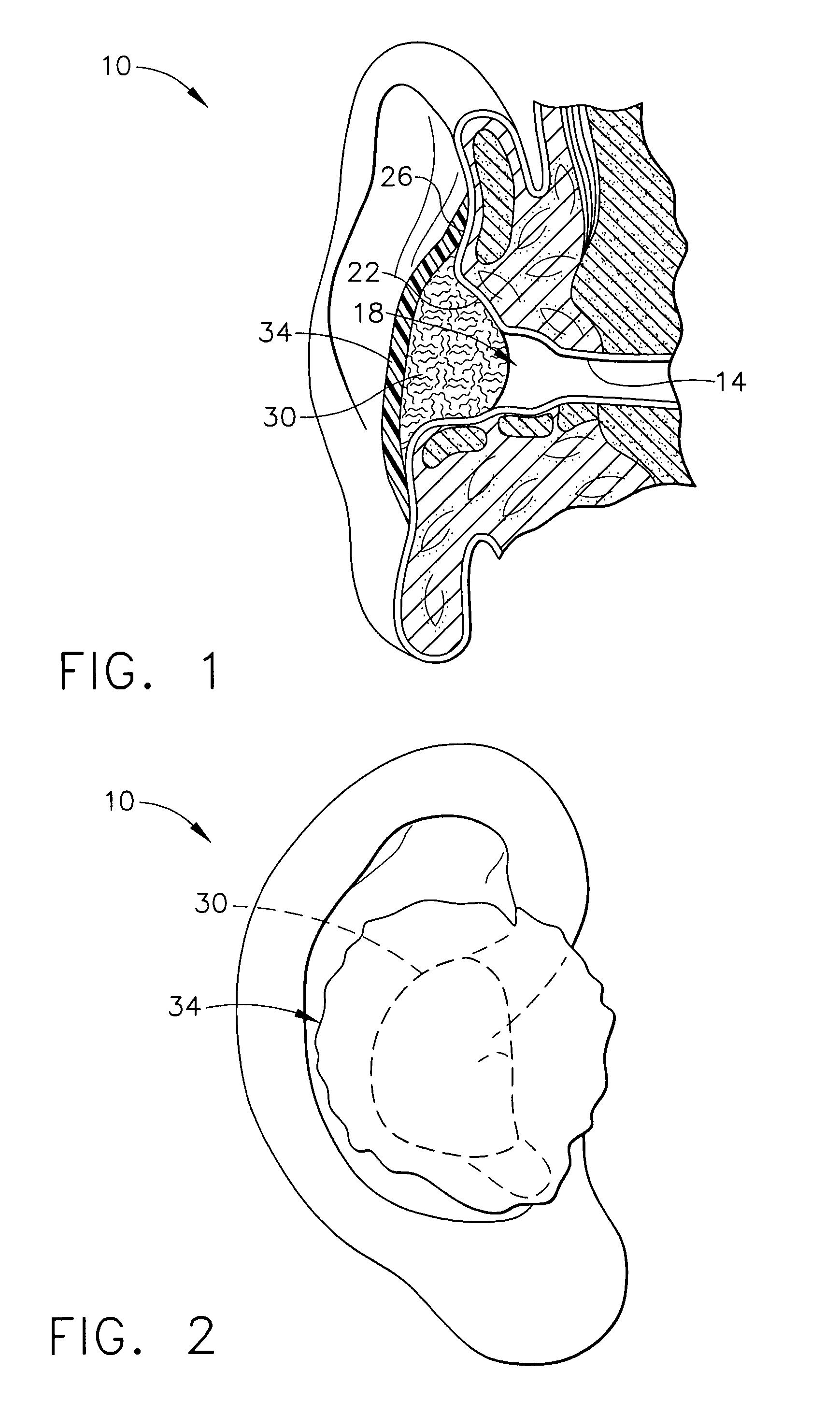 Method for forming occlusive barrier over ear canal and kit for providing same