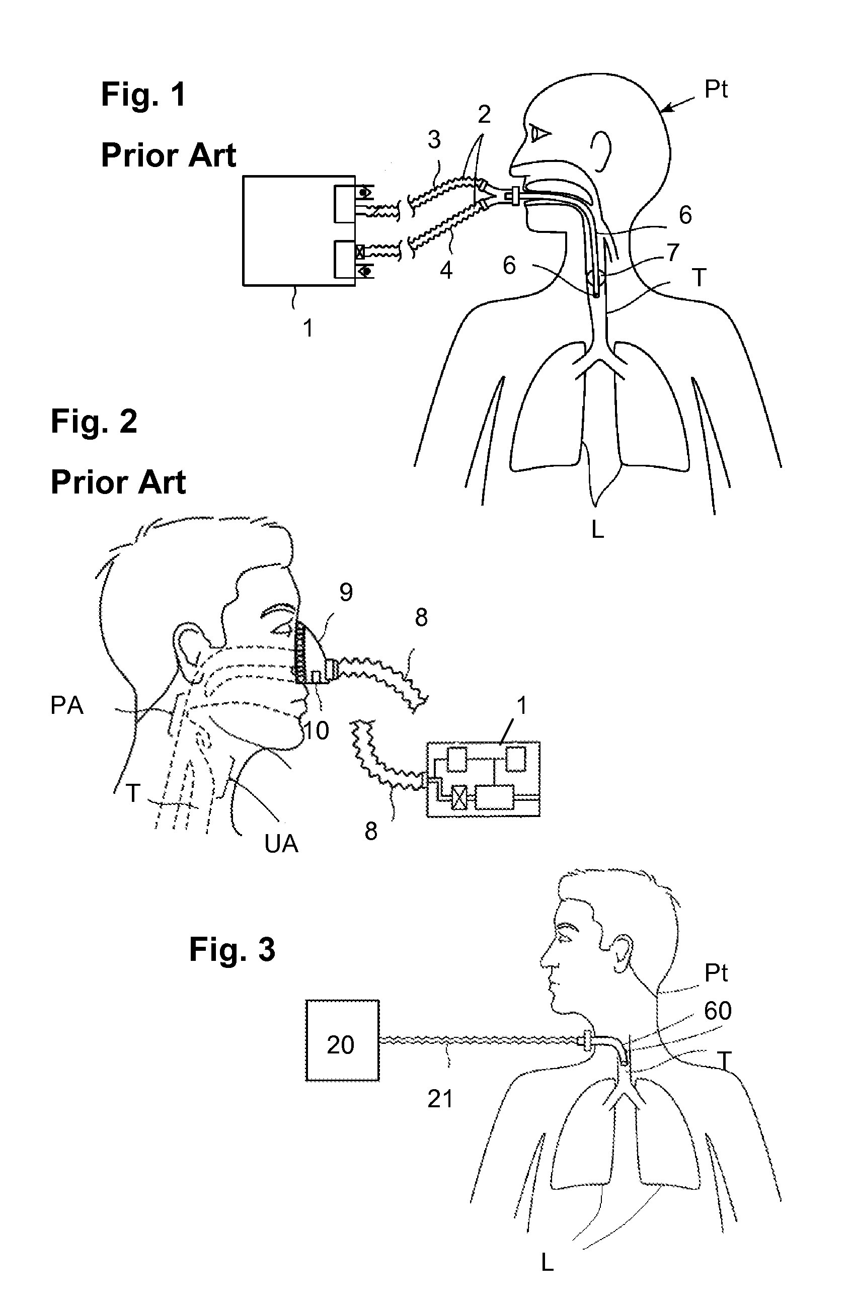Methods and devices for providing mechanical ventilation with an open airway interface