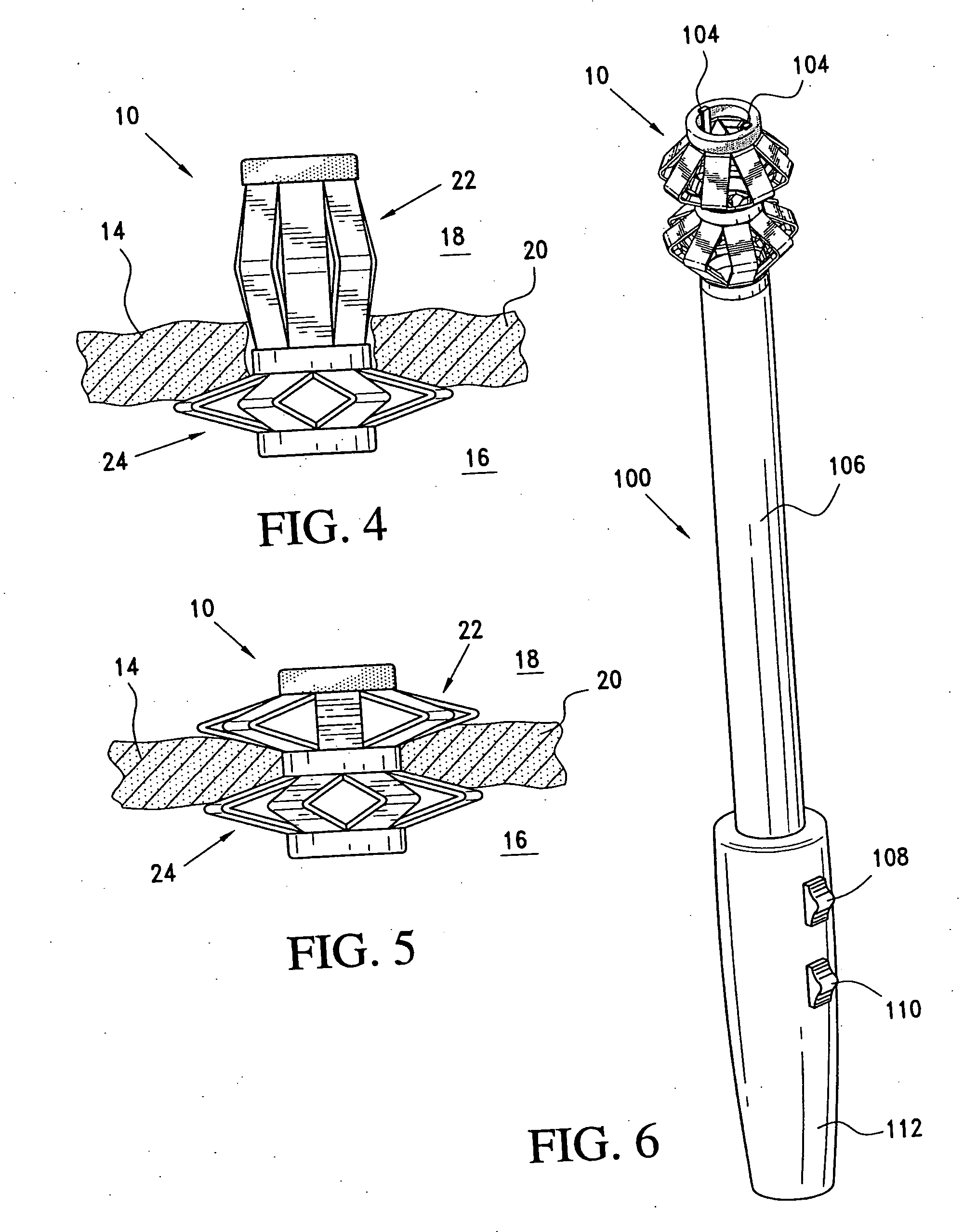 Method and apparatus for sealing a gastric opening