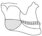 Invisible correction method for treating class 2 and class 3 malocclusion by using occlusion repositioning device