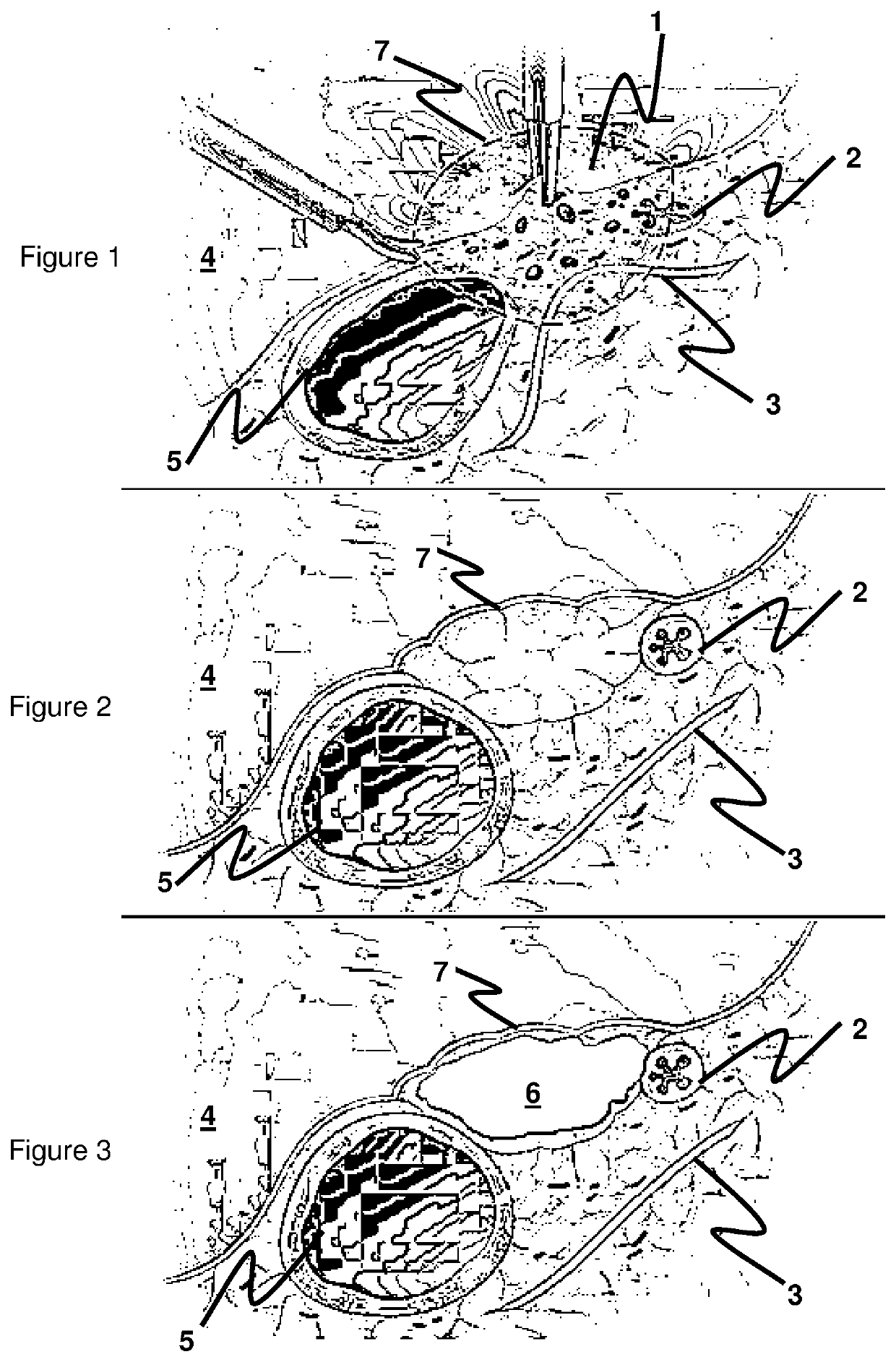 Therapeutic composition for endometriosis surgery and method for using the same