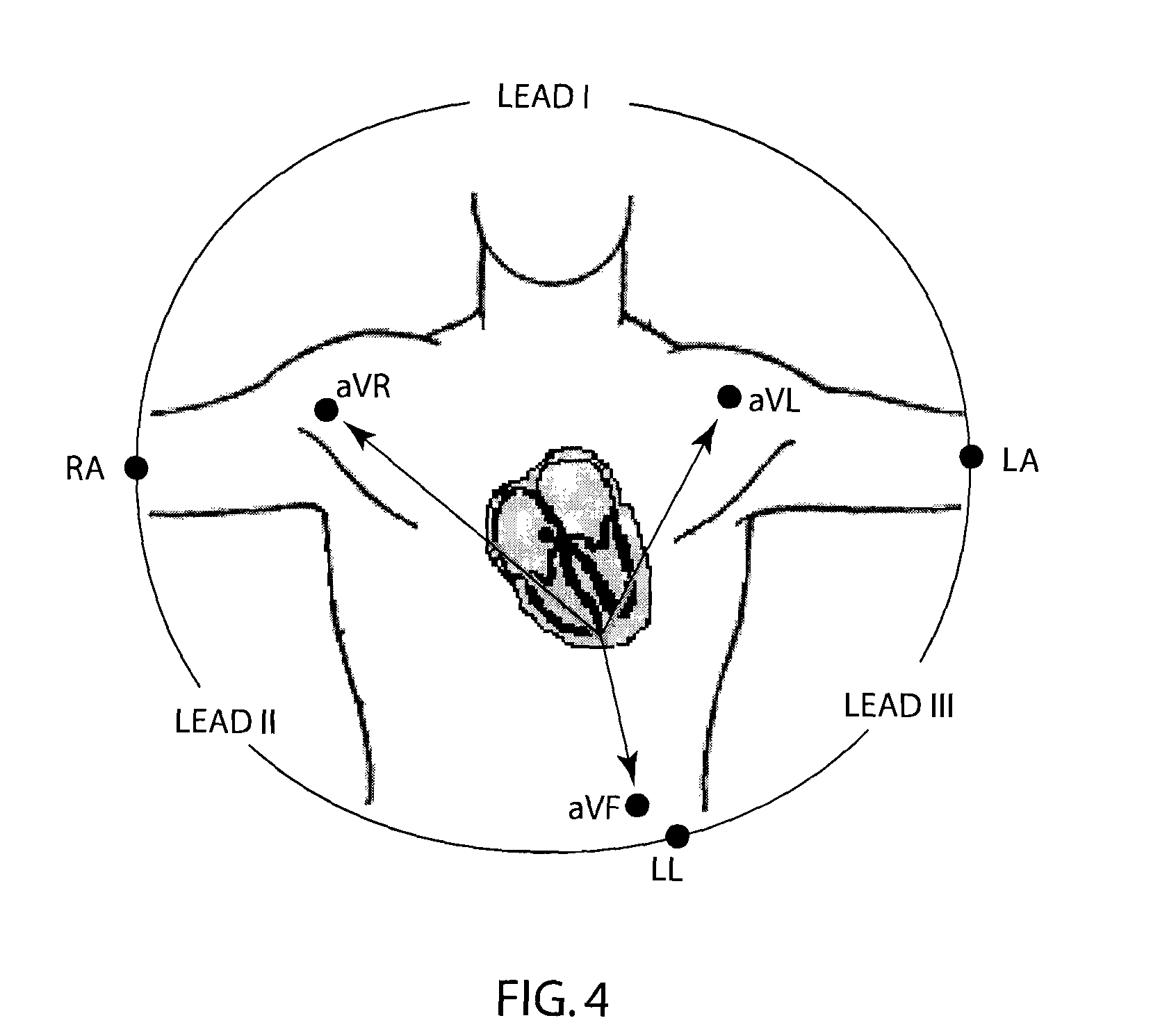Method and apparatus with reduced electrode system specific ECG interpretation