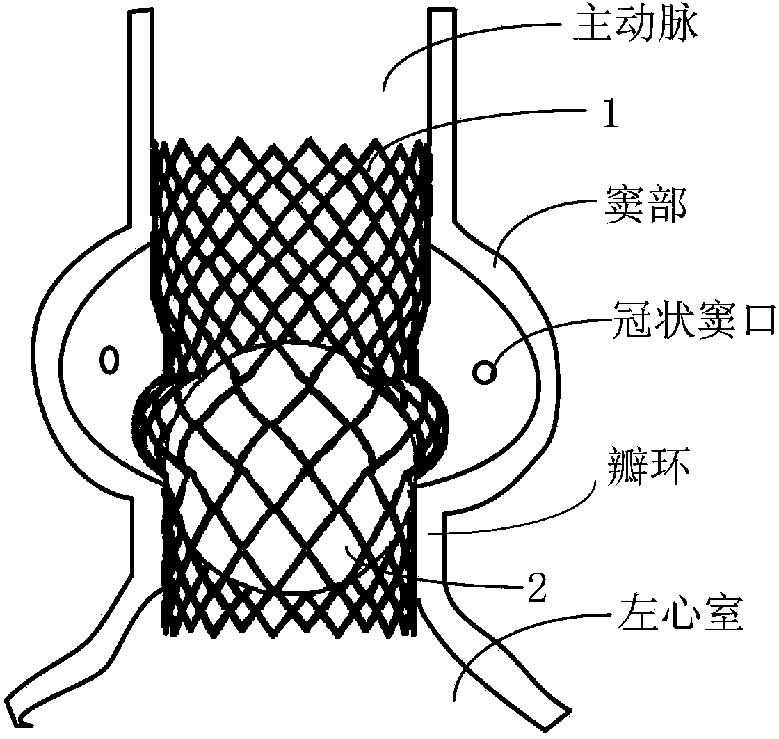 Liquid injection type cage ball aortic valve support system