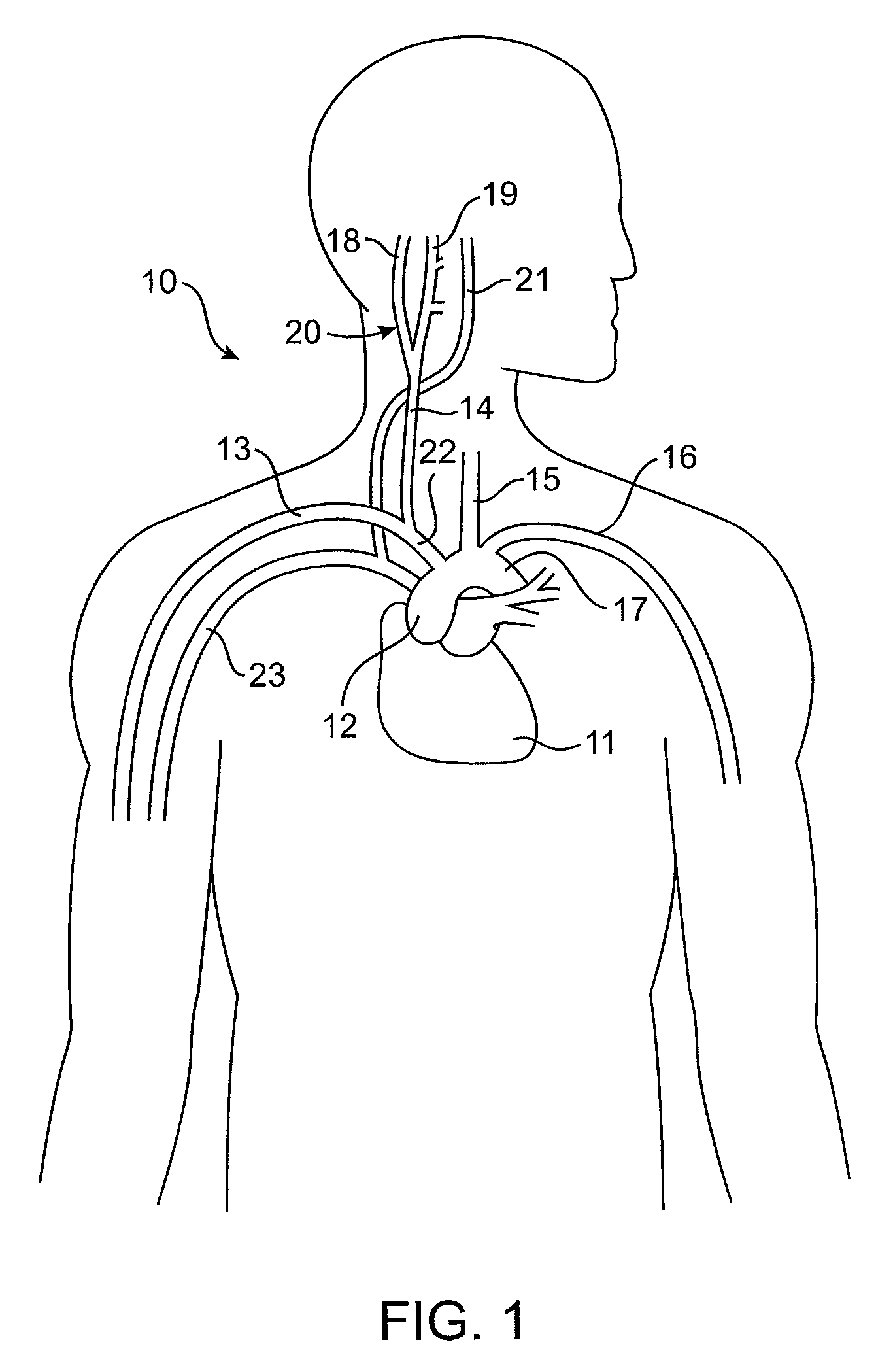 Baroreflex Activation Therapy With Incrementally Changing Intensity