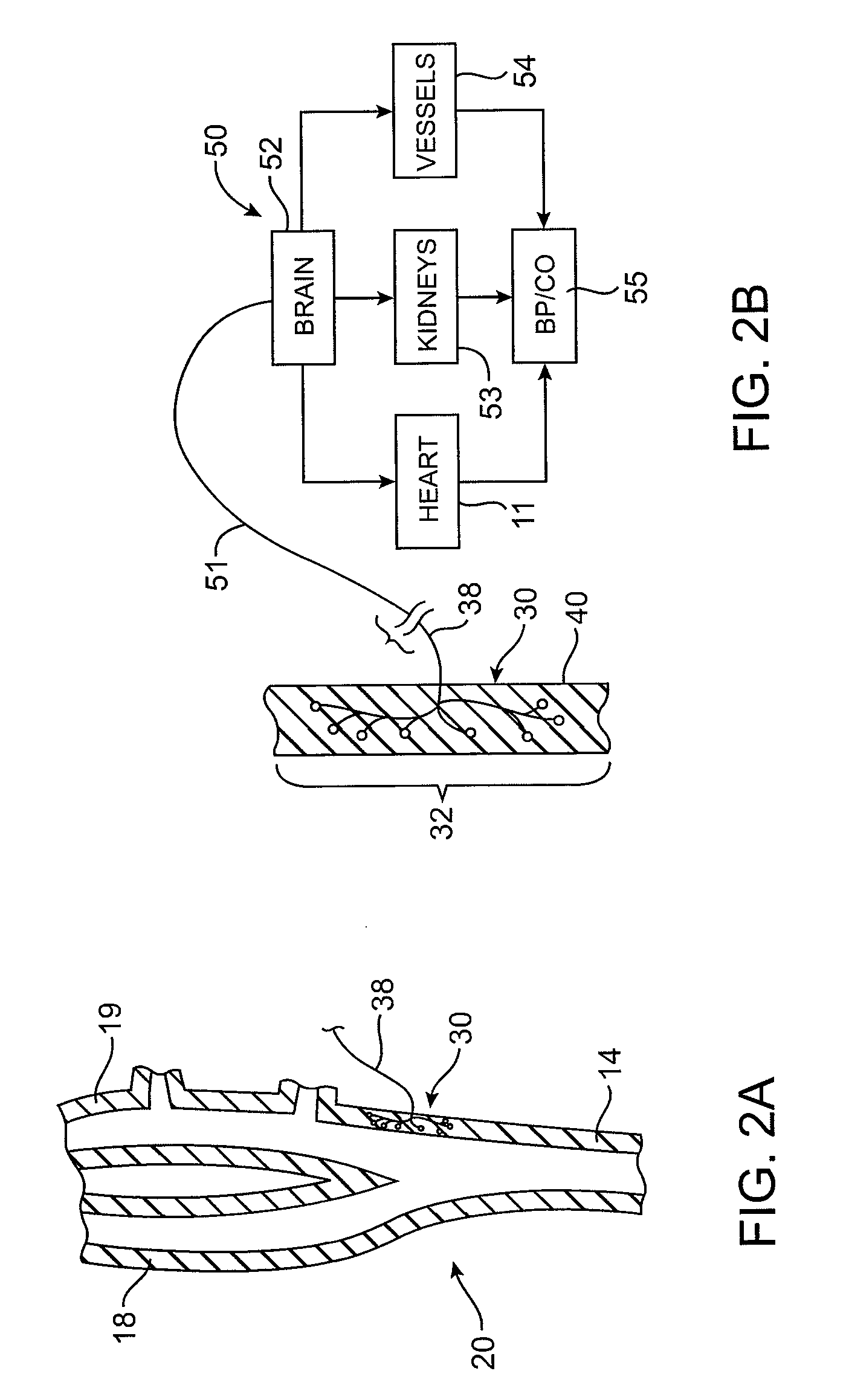 Baroreflex Activation Therapy With Incrementally Changing Intensity