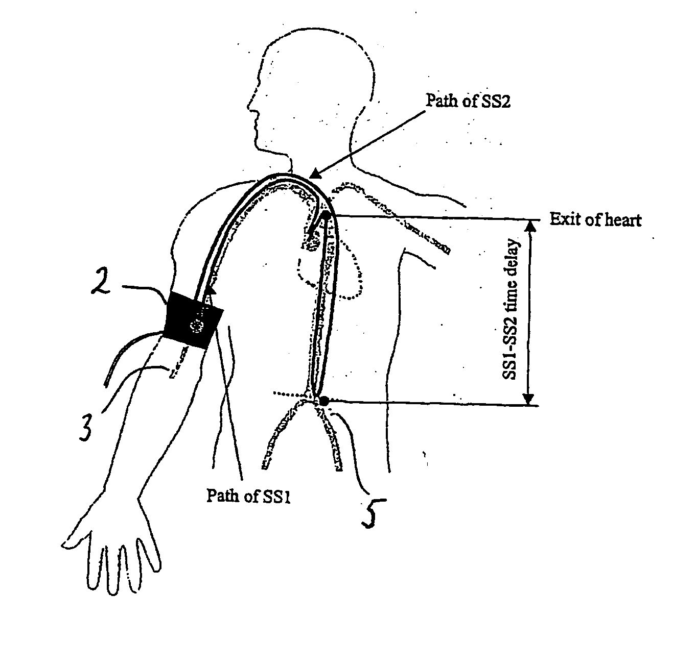 System and method for non-invasive cardiovascular assessment from supra-systolic signals obtained with a wideband external pulse transducer in a blood pressure cuff