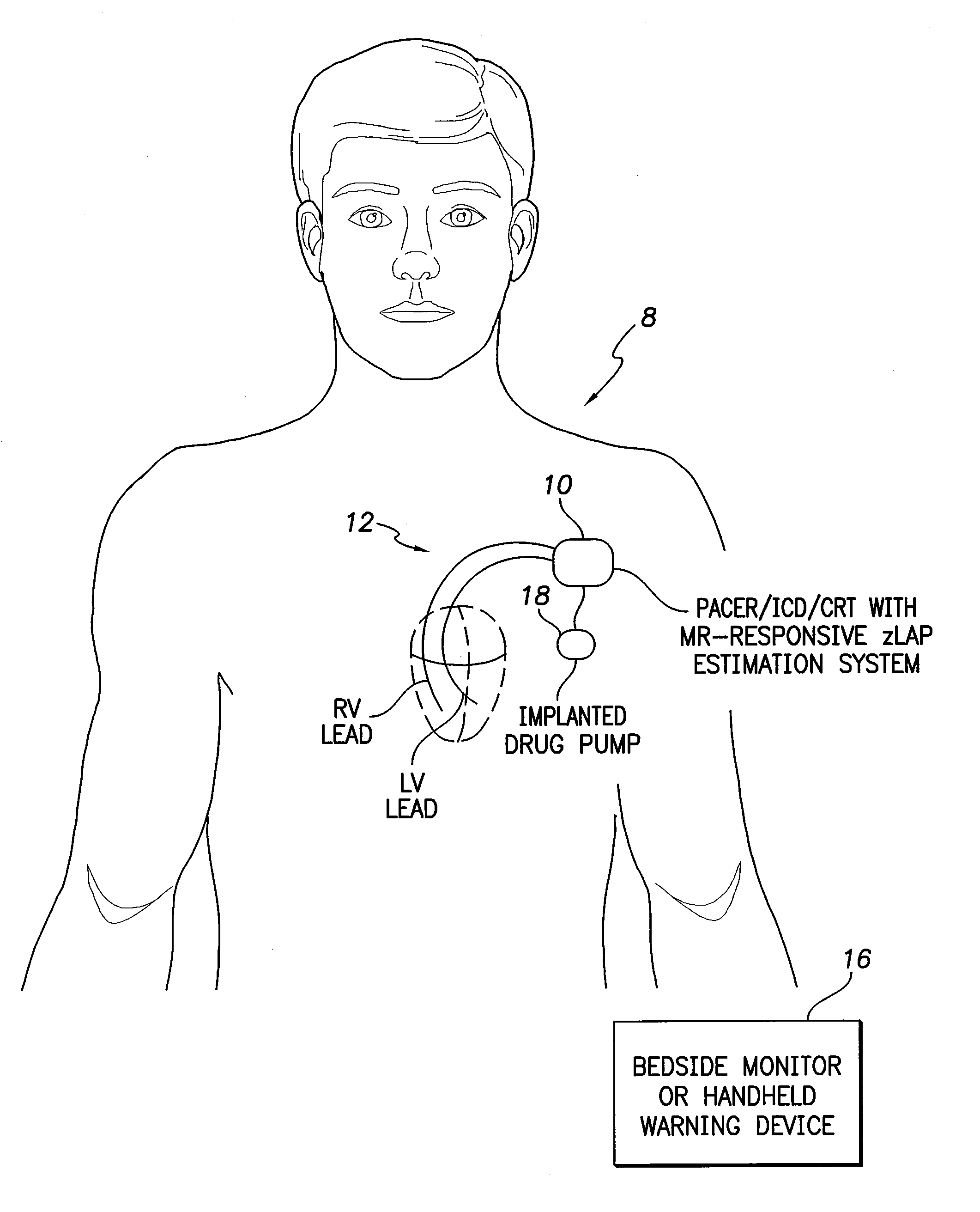 Systems and methods for estimating left atrial pressure (LAP) in patients with acute mitral valve regurgitation for use by an implantable medical device