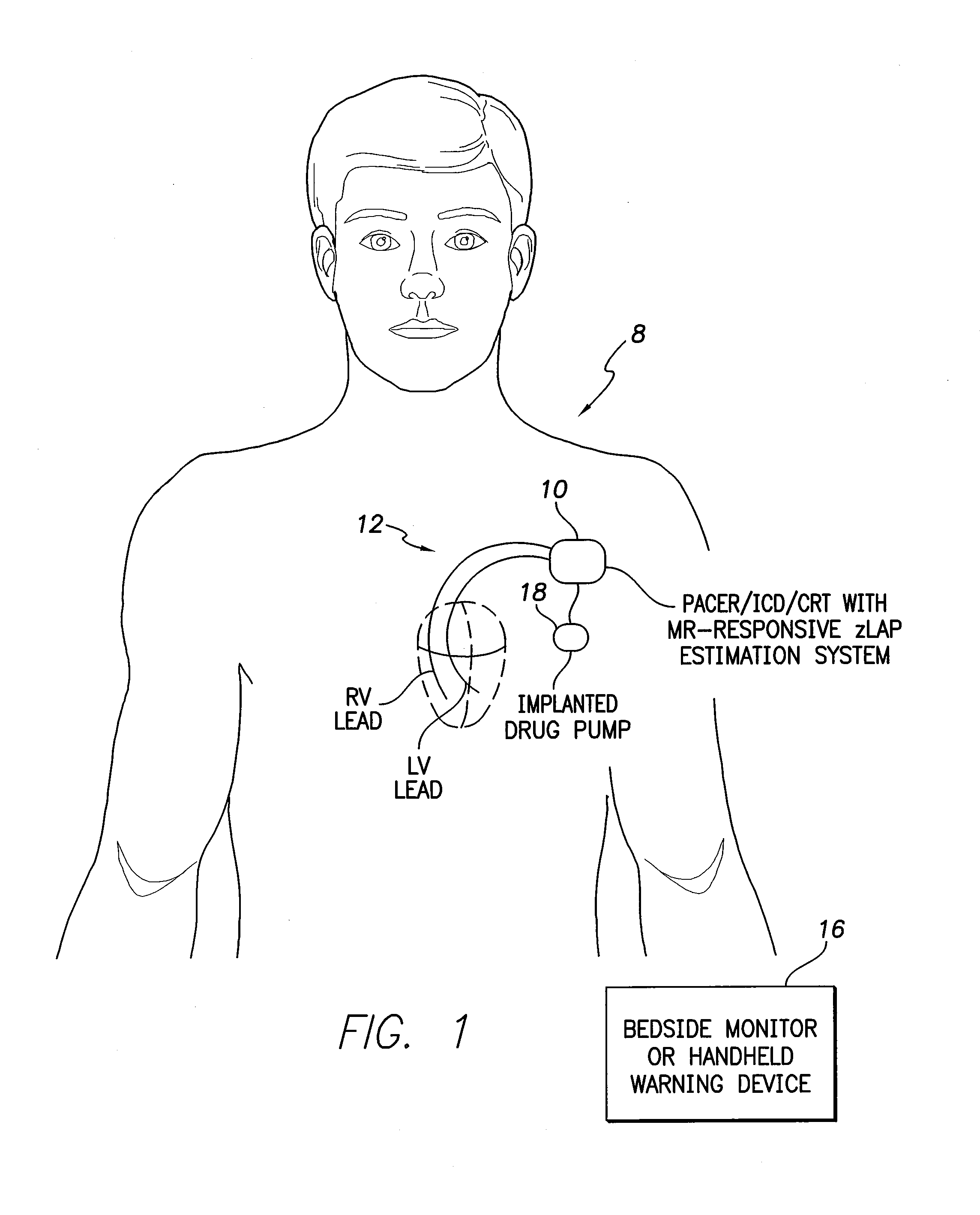 Systems and methods for estimating left atrial pressure (LAP) in patients with acute mitral valve regurgitation for use by an implantable medical device