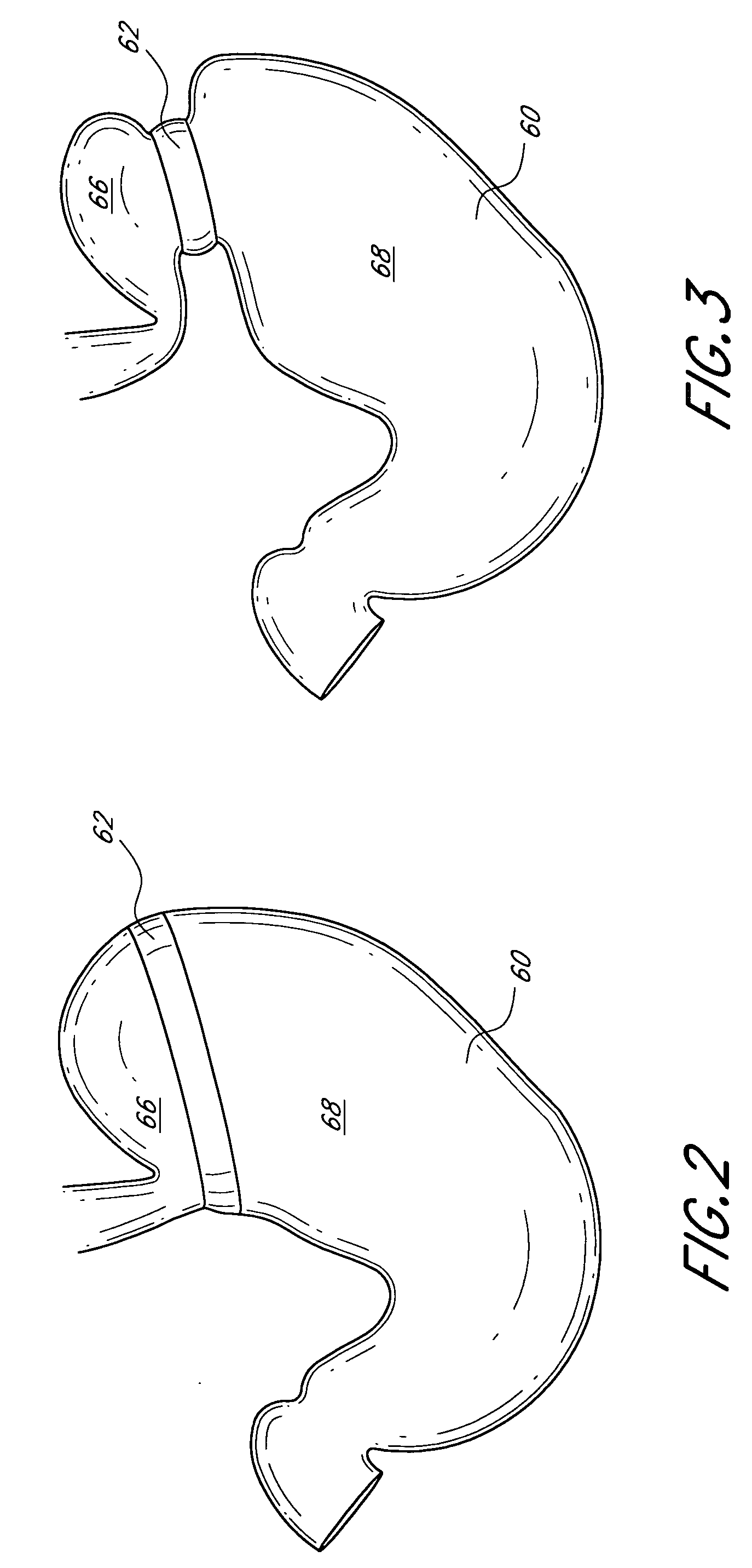 Dynamically adjustable gastric implants and methods of treating obesity using dynamically adjustable gastric implants