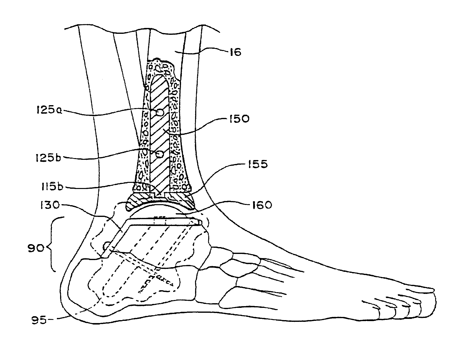Systems and methods for installing ankle replacement prostheses