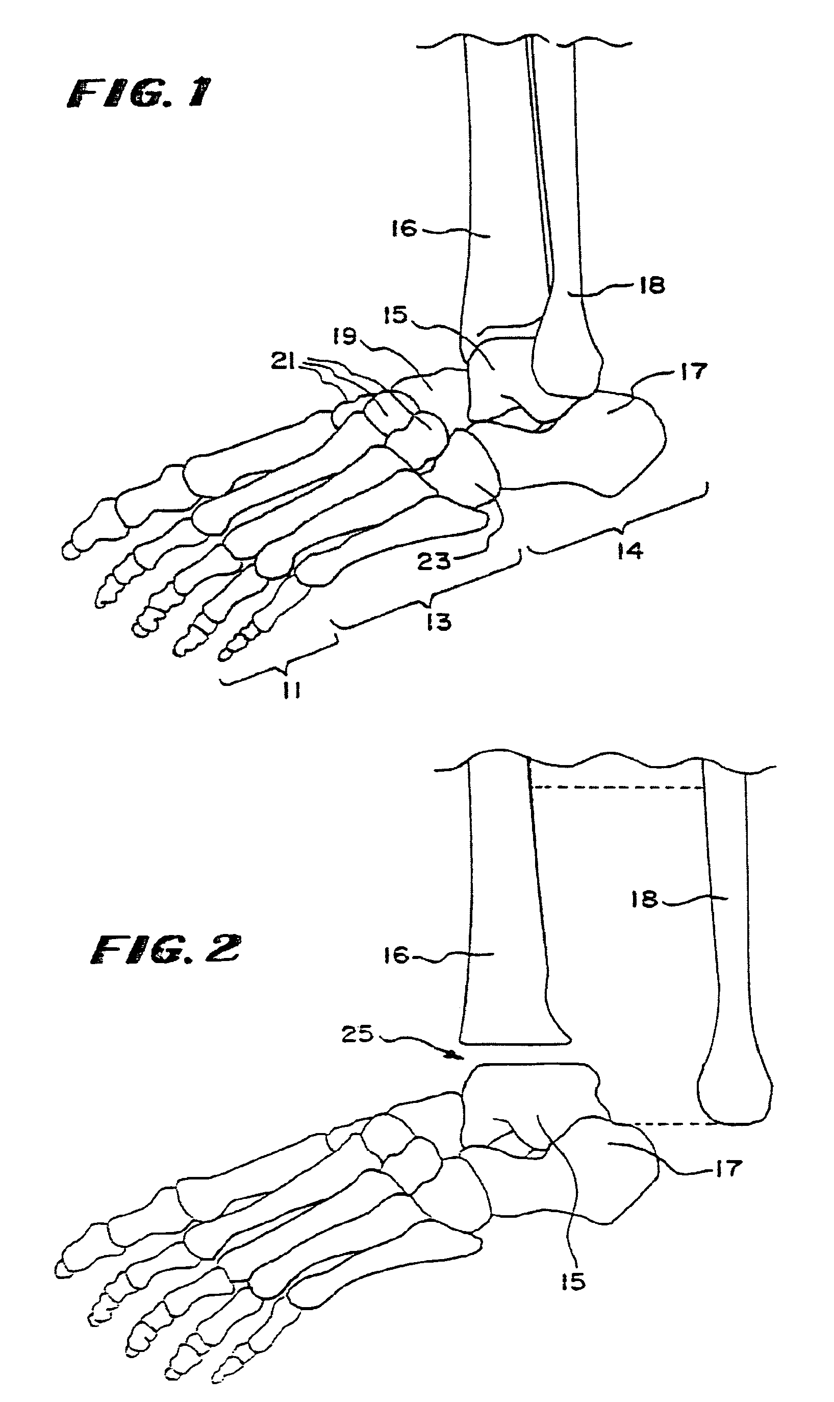 Systems and methods for installing ankle replacement prostheses