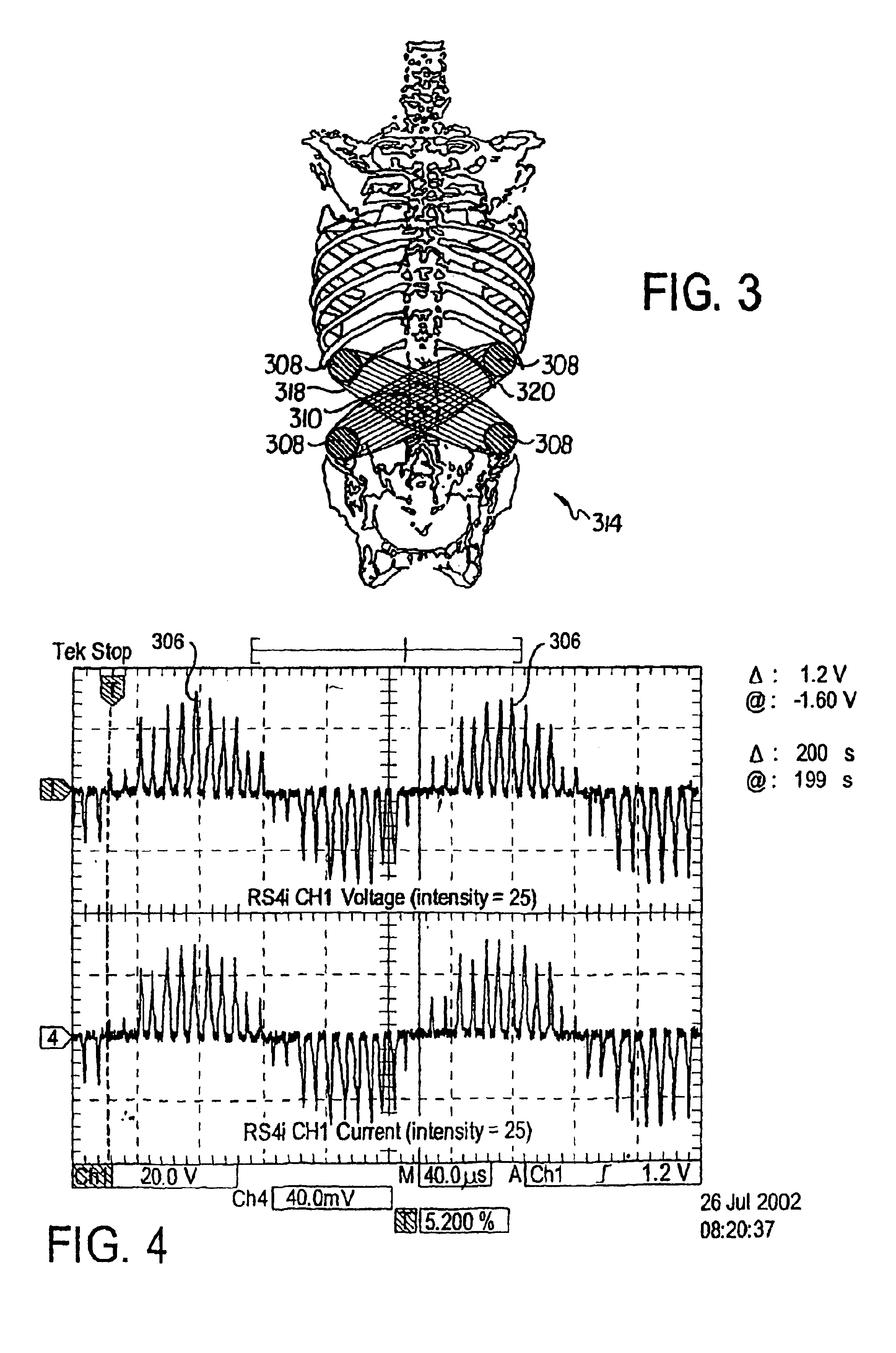 Osteogenesis stimulator with digital signal processing