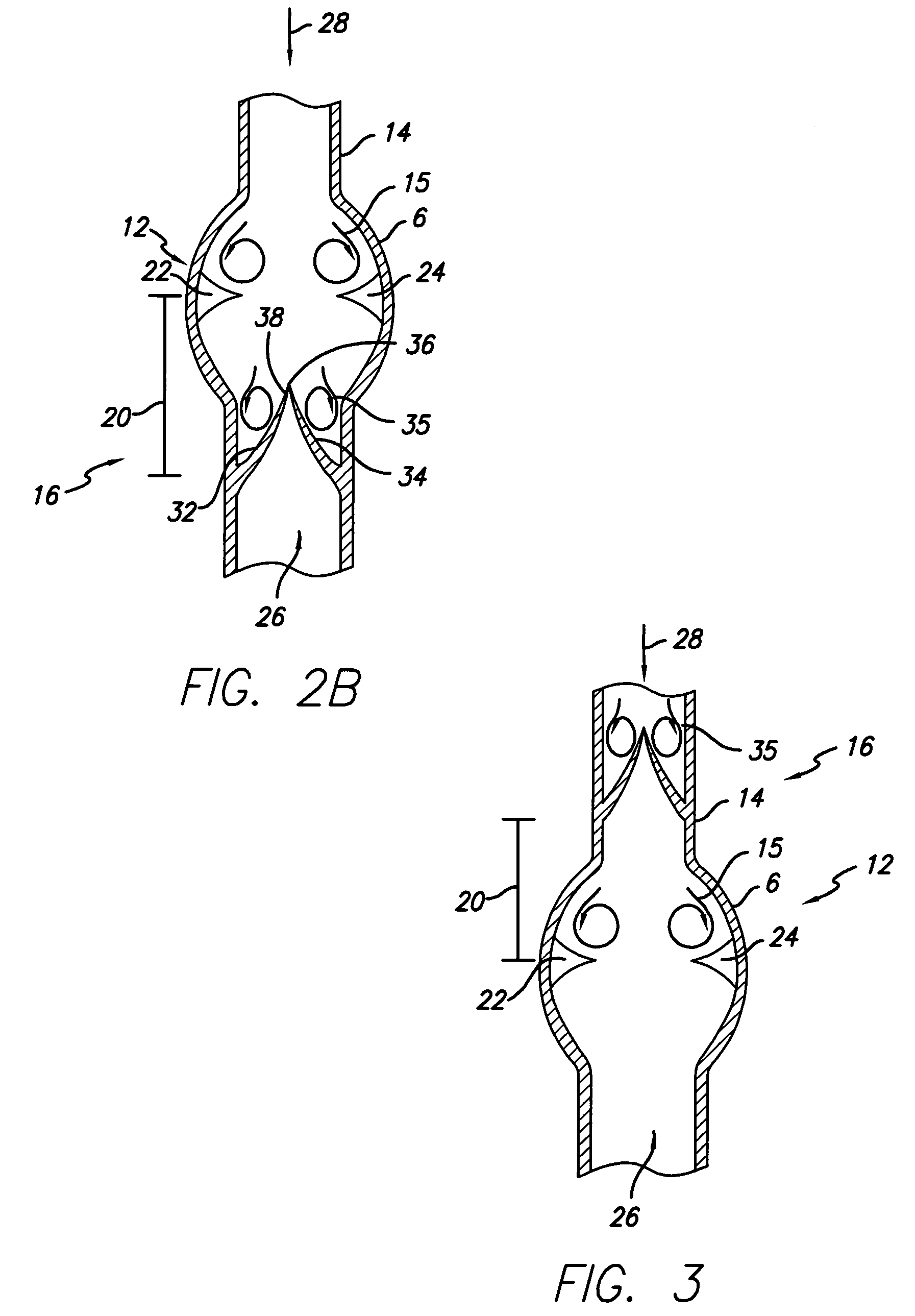 Method for implanting prosthetic valves