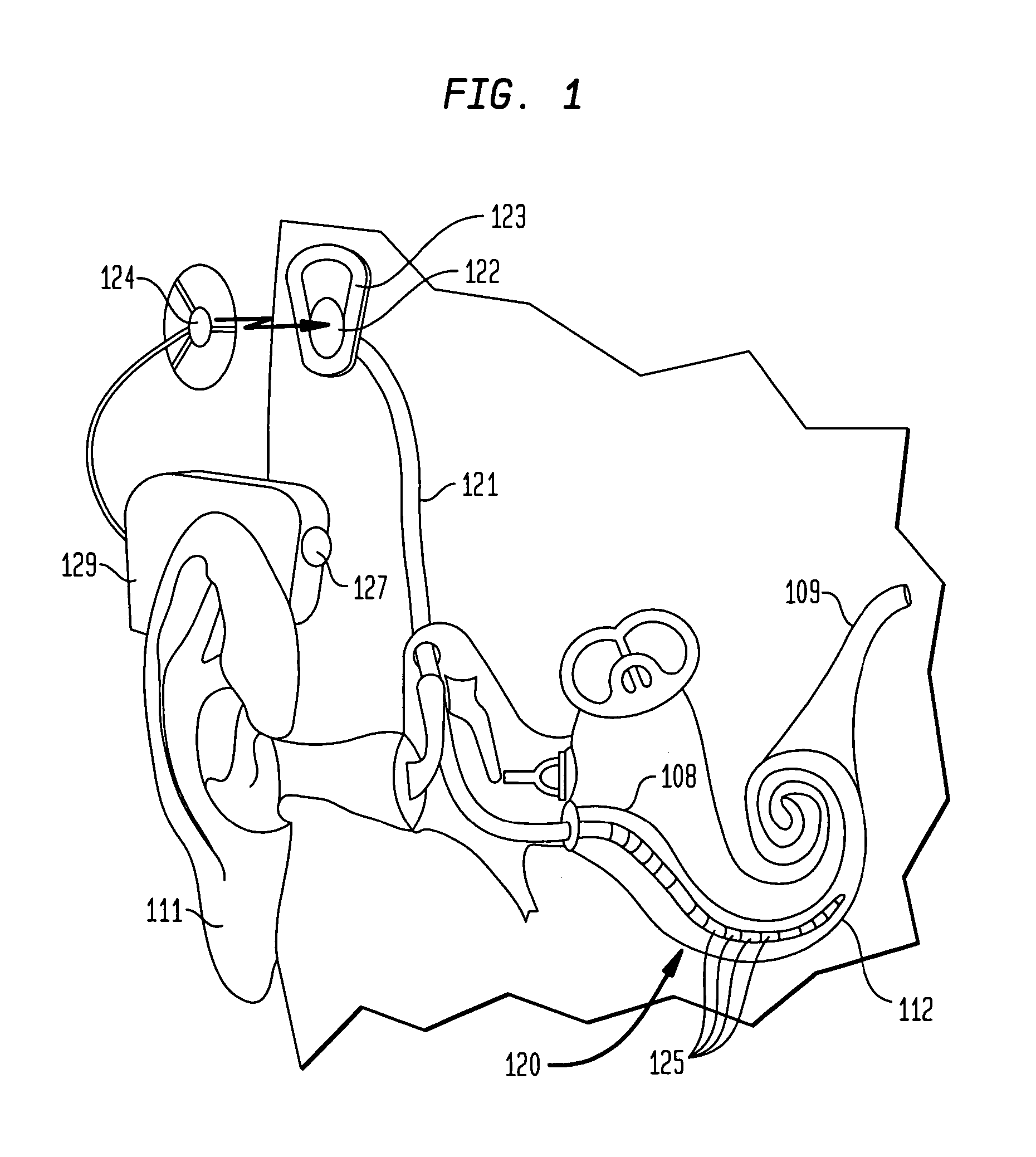 Simultaneous delivery of electrical and acoustical stimulation in a hearing prosthesis