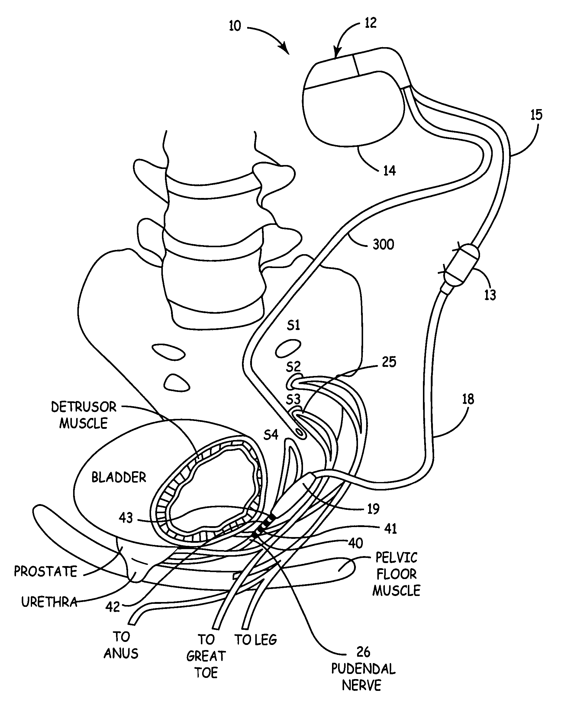 Method, system and device for treating disorders of the pelvic floor by delivering drugs to various nerves or tissues