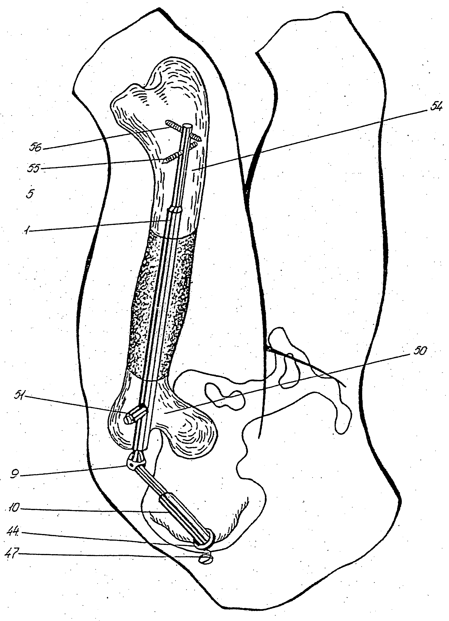 Bliskunov device for elongating long bones