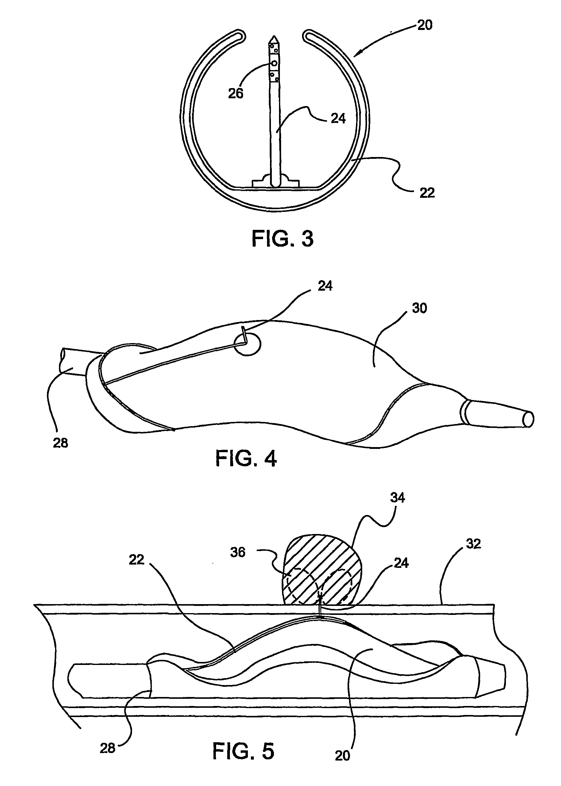 Medical devices with proteasome inhibitors for the treatment of restenosis