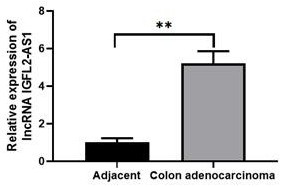 Application of lncRNA IGFL2-AS1 as a diagnostic marker for colon cancer