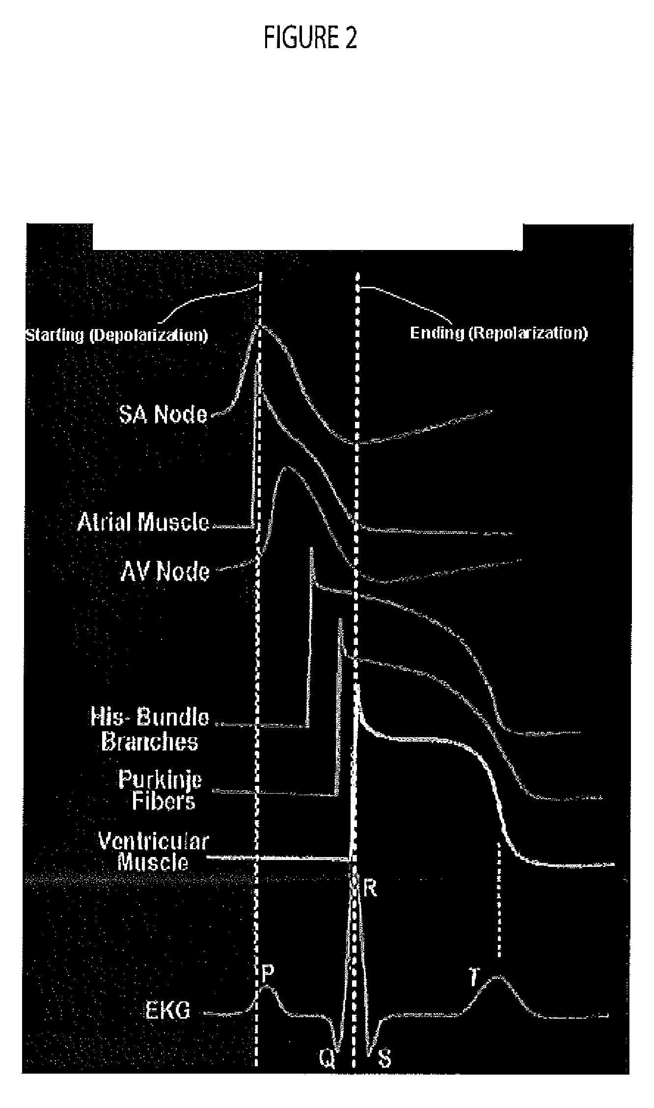 System for cardiac medical condition detection