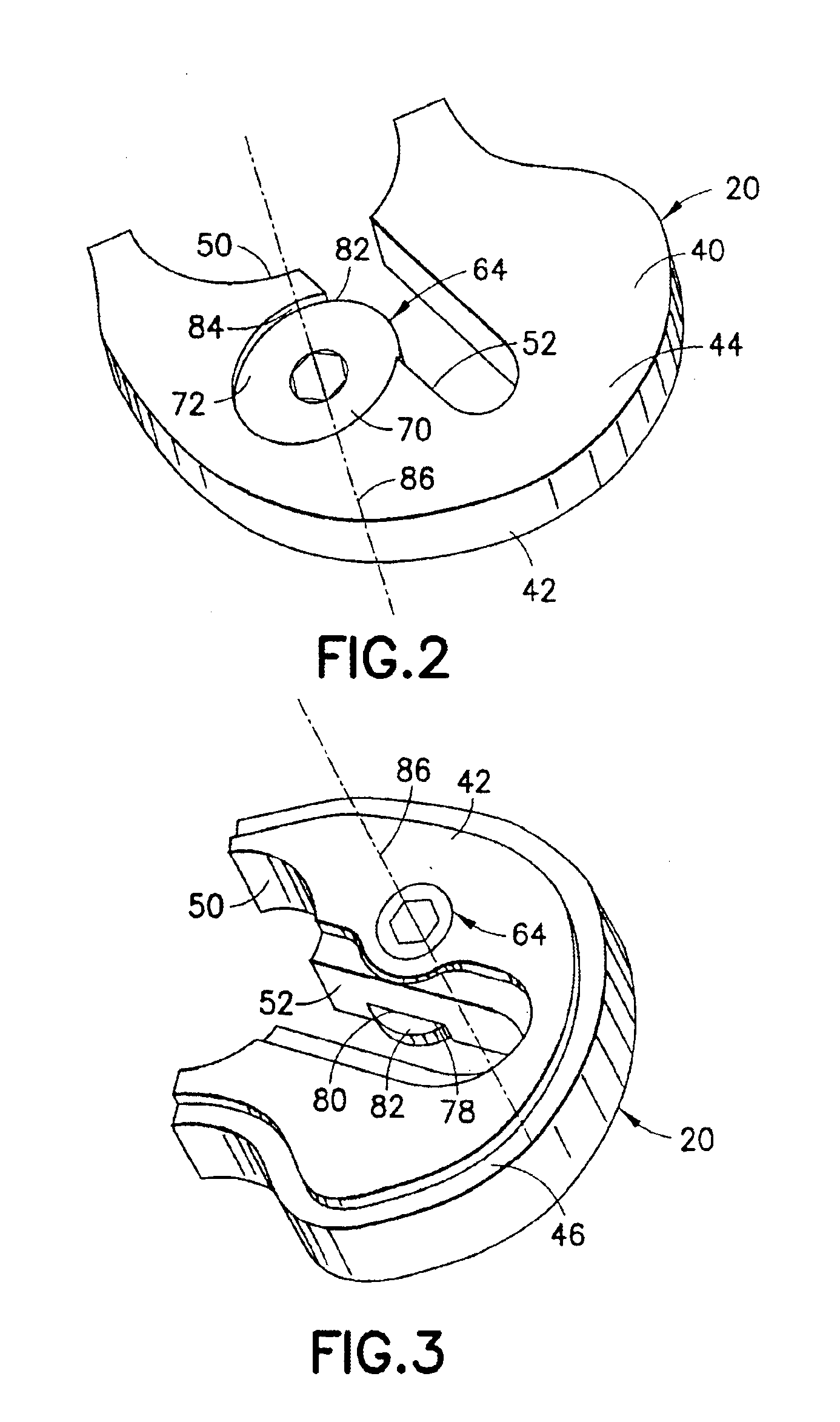 Securing an augment to a prosthetic implant component