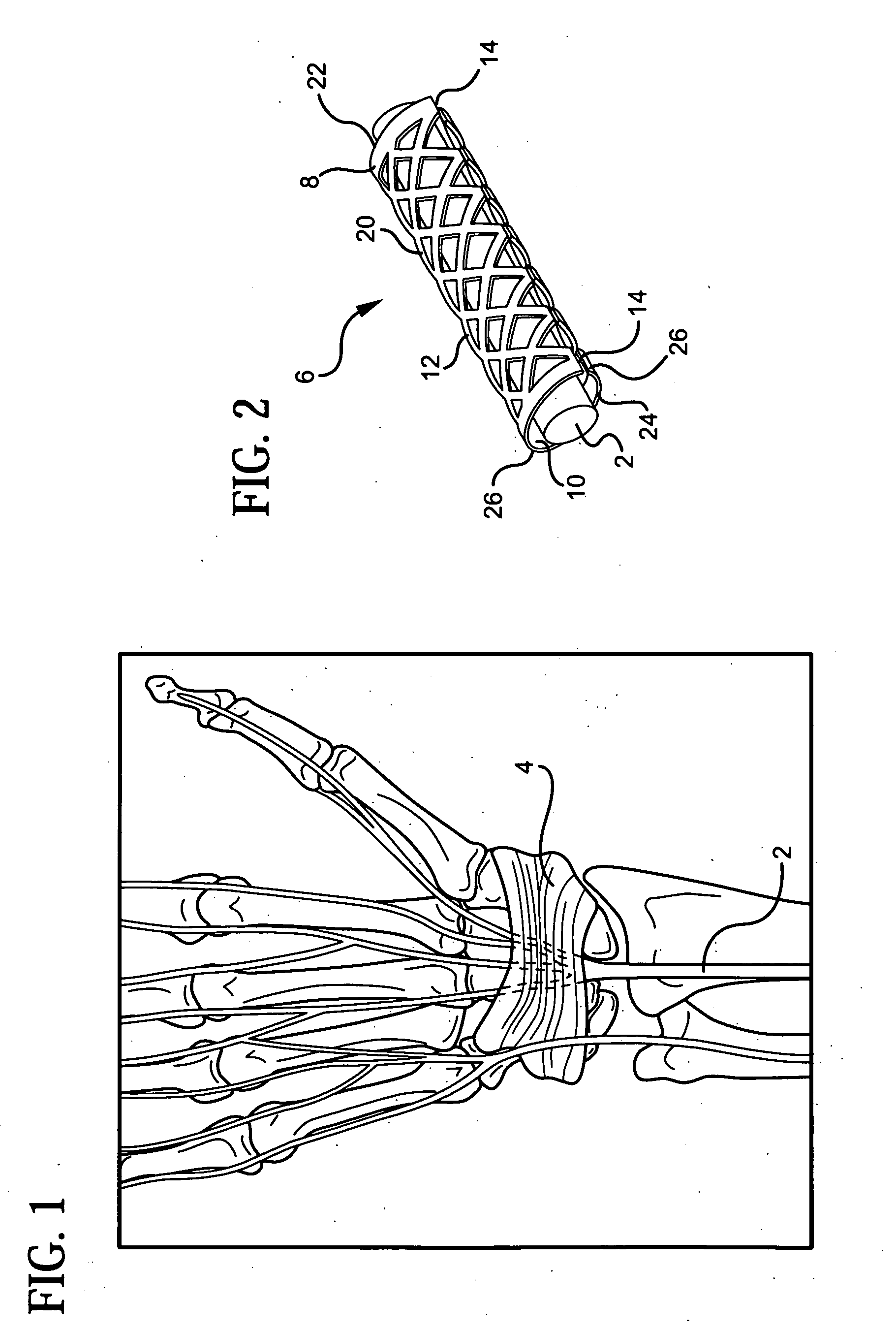 Device for treating carpal tunnel syndrome