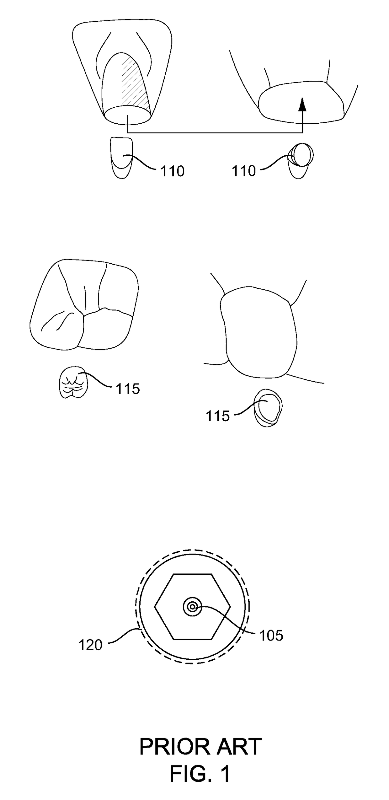 Fulcrum implant systems