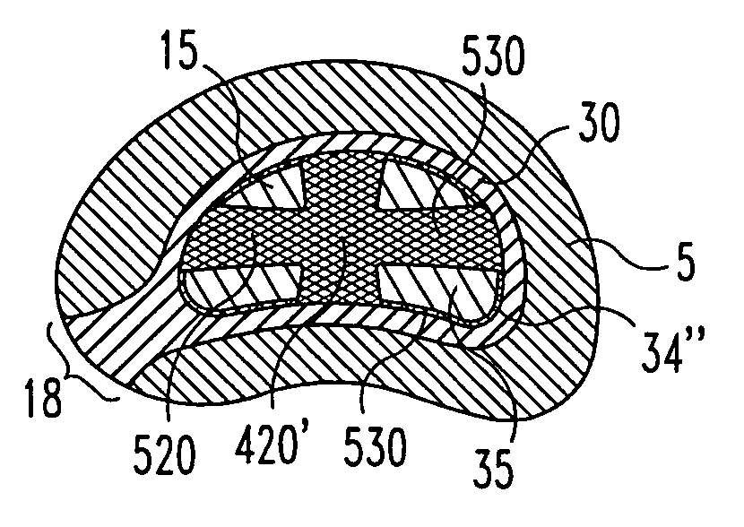Composite intervertebral disc implants and methods for forming the same
