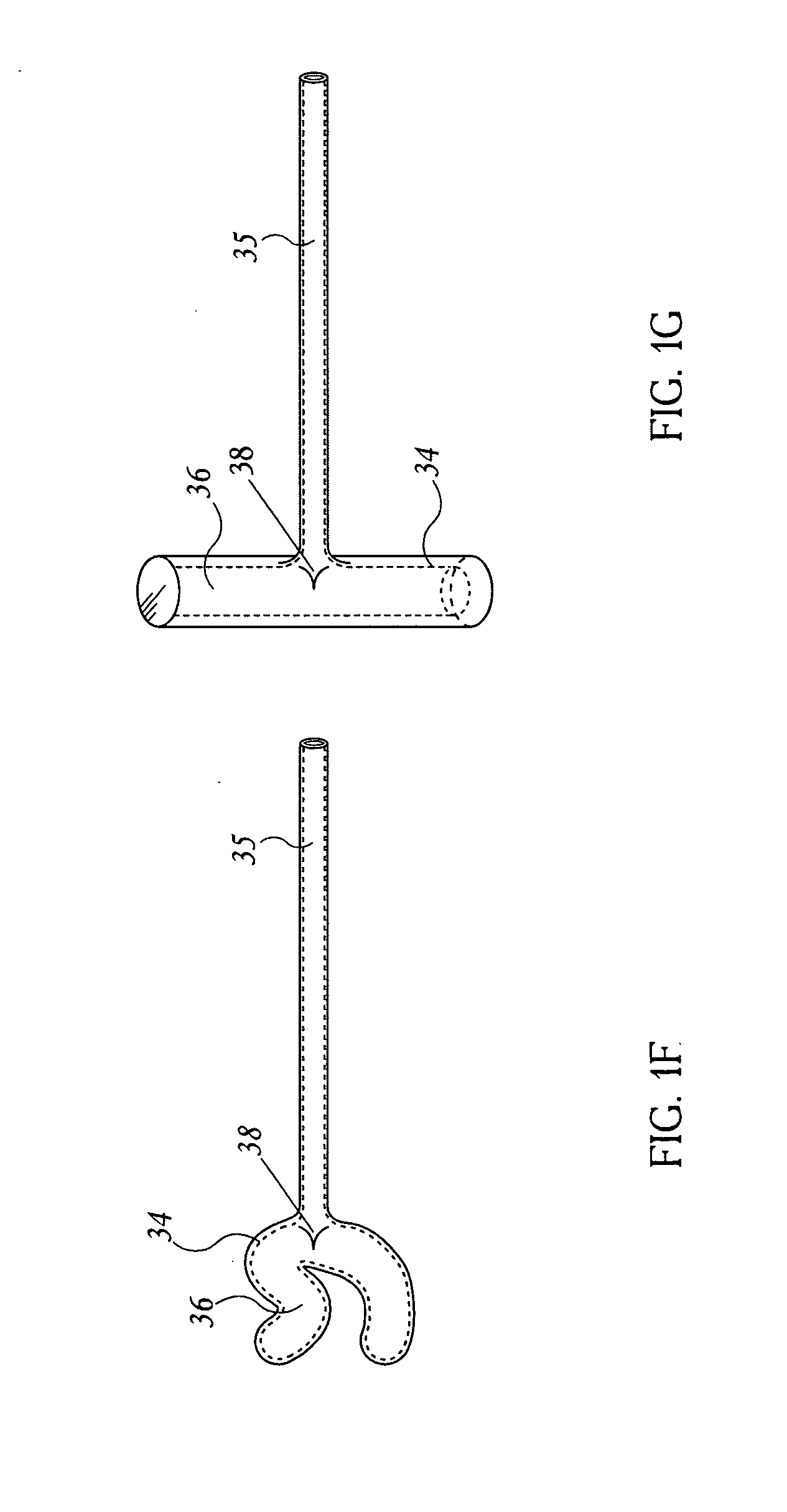 Methods and devices for the surgical creation of satiety and biofeedback pathways
