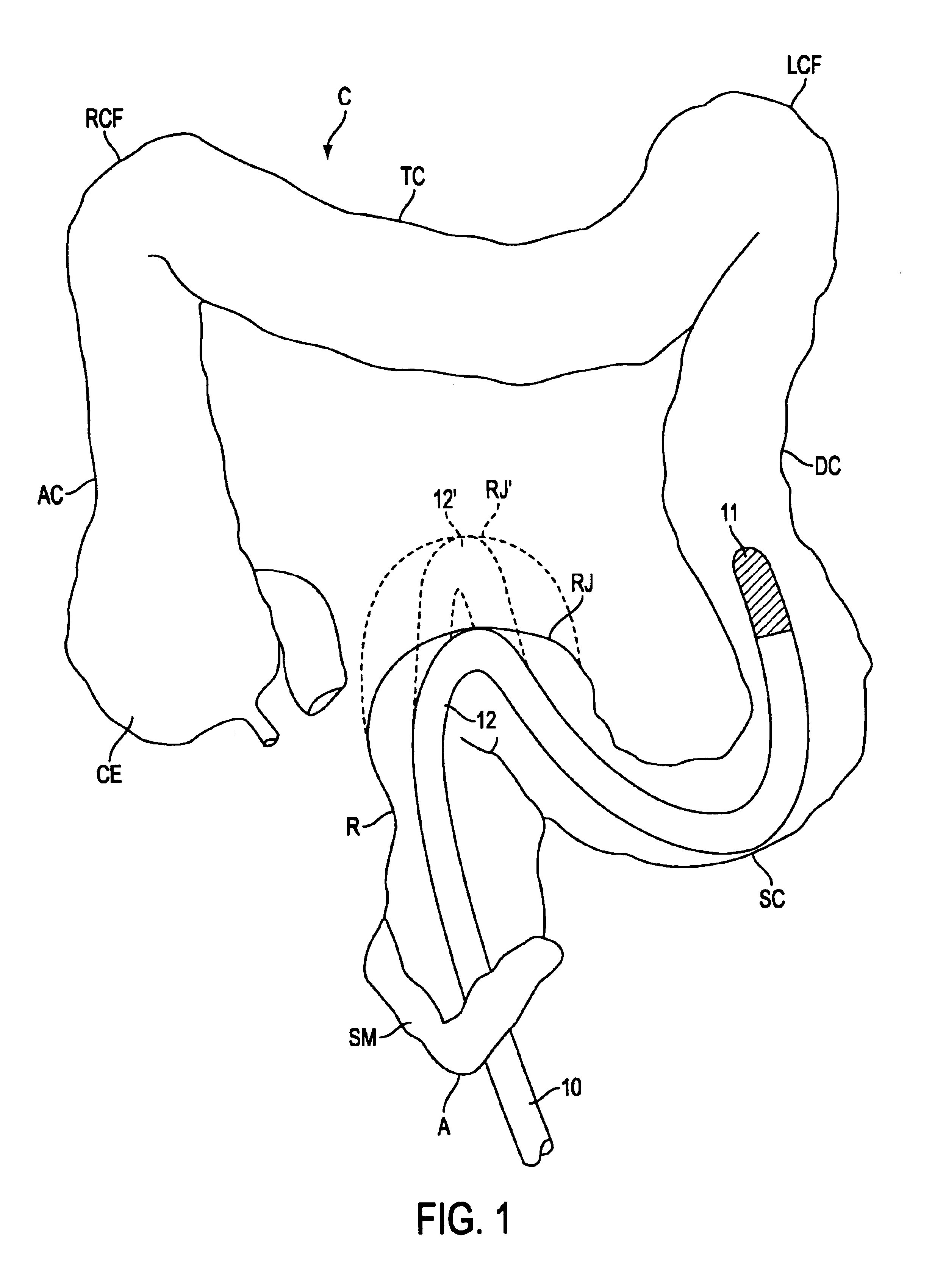 Shape lockable apparatus and method for advancing an instrument through unsupported anatomy