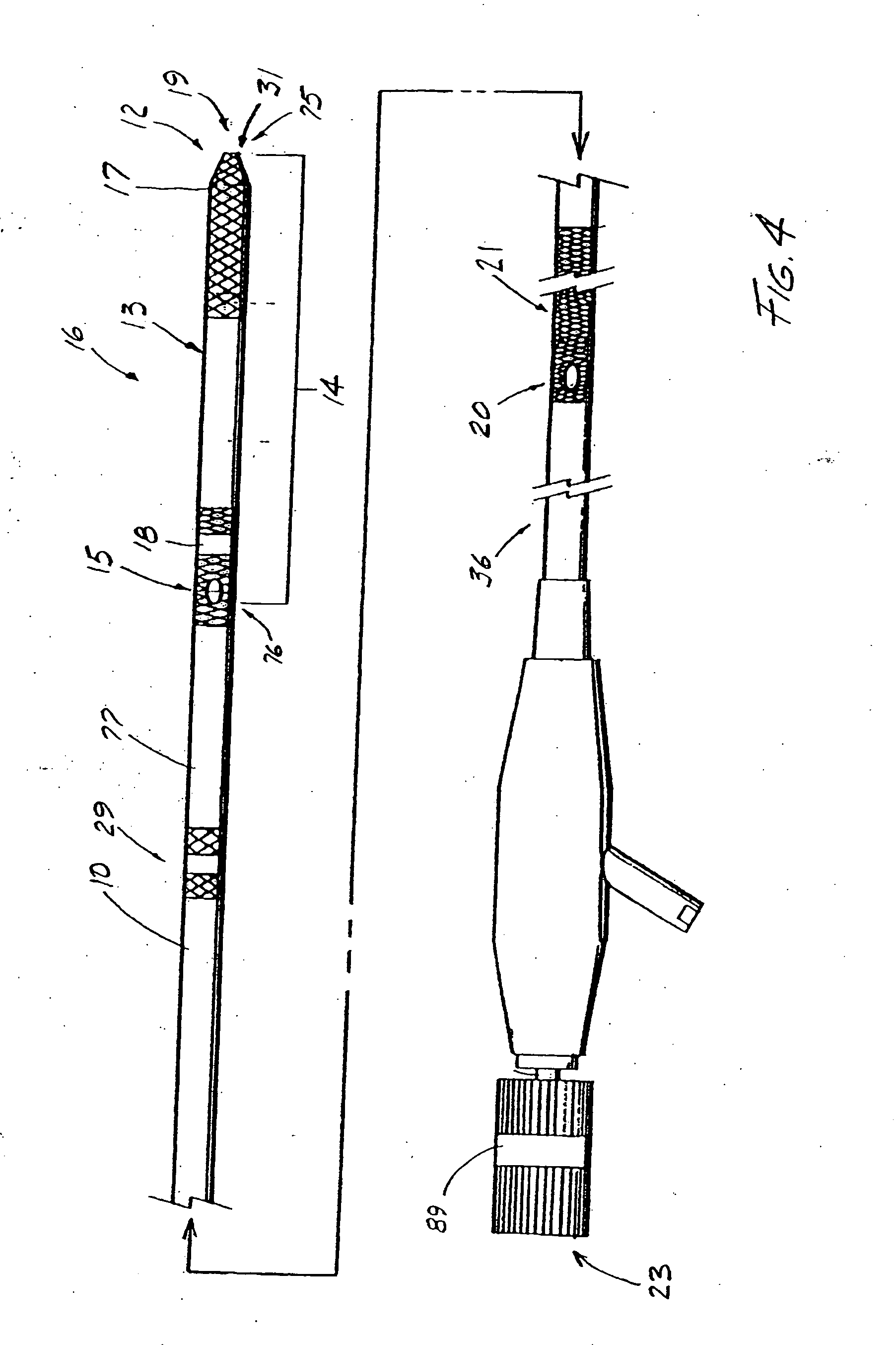 Catheter with splittable wall shaft and peel tool