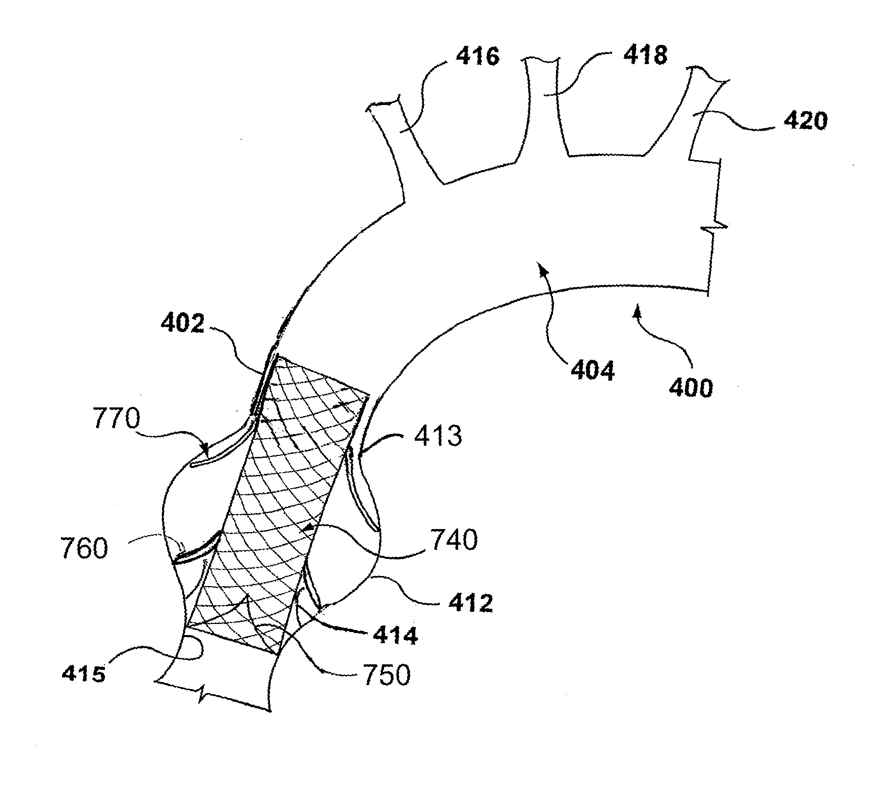 Modular valve prosthesis with anchor stent and valve component