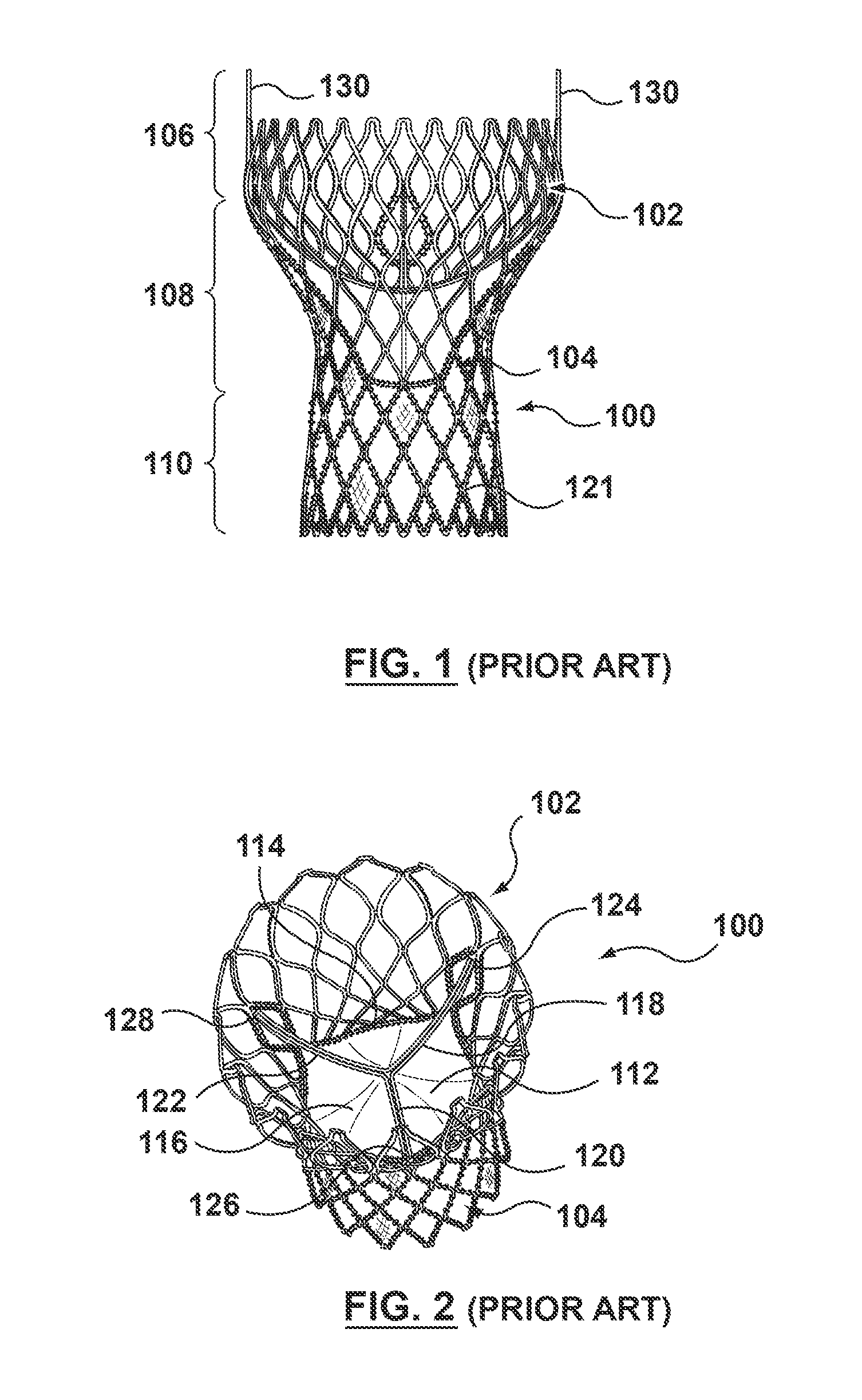 Modular valve prosthesis with anchor stent and valve component