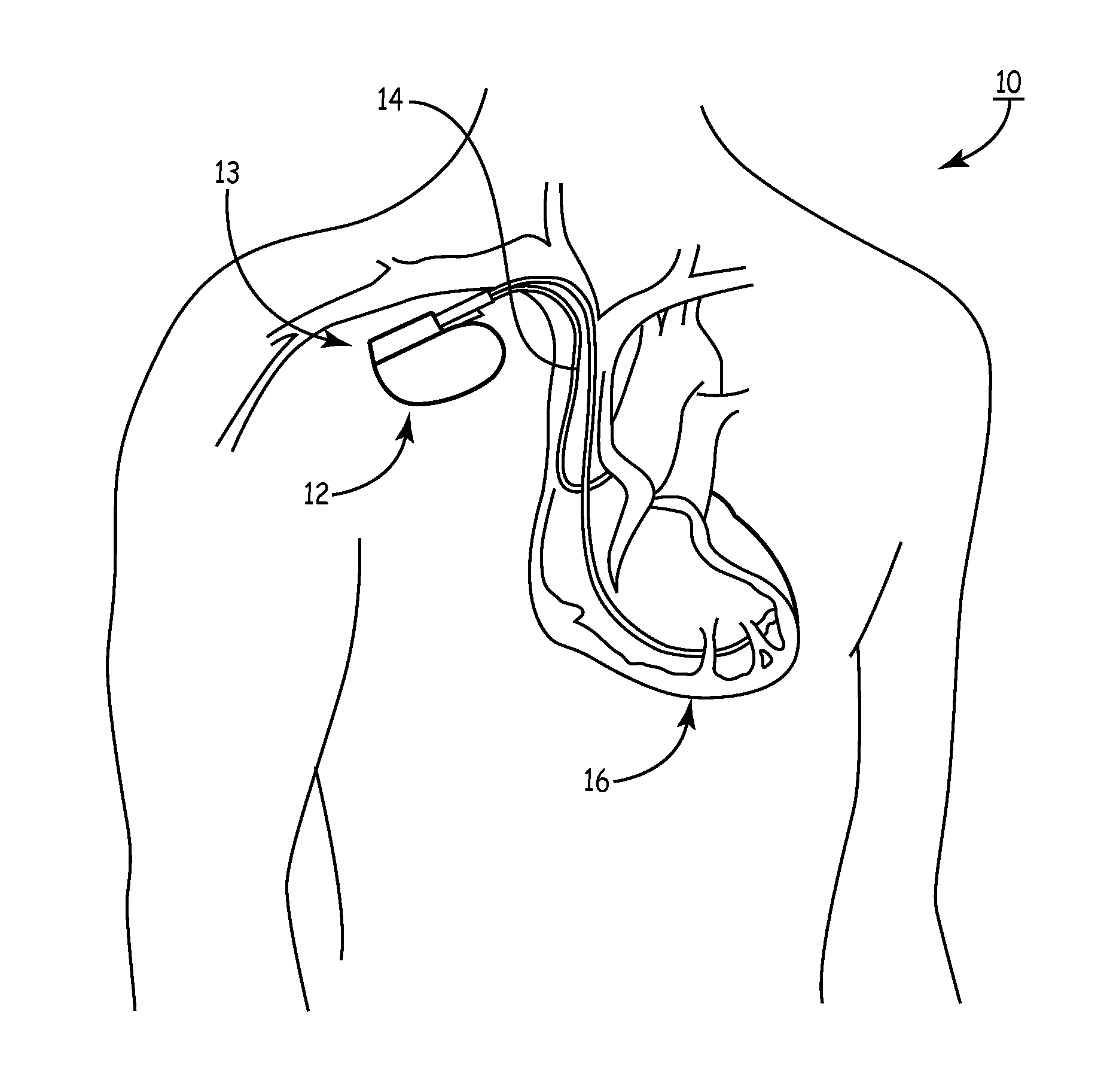 Resonance tuning module for implantable devices and leads