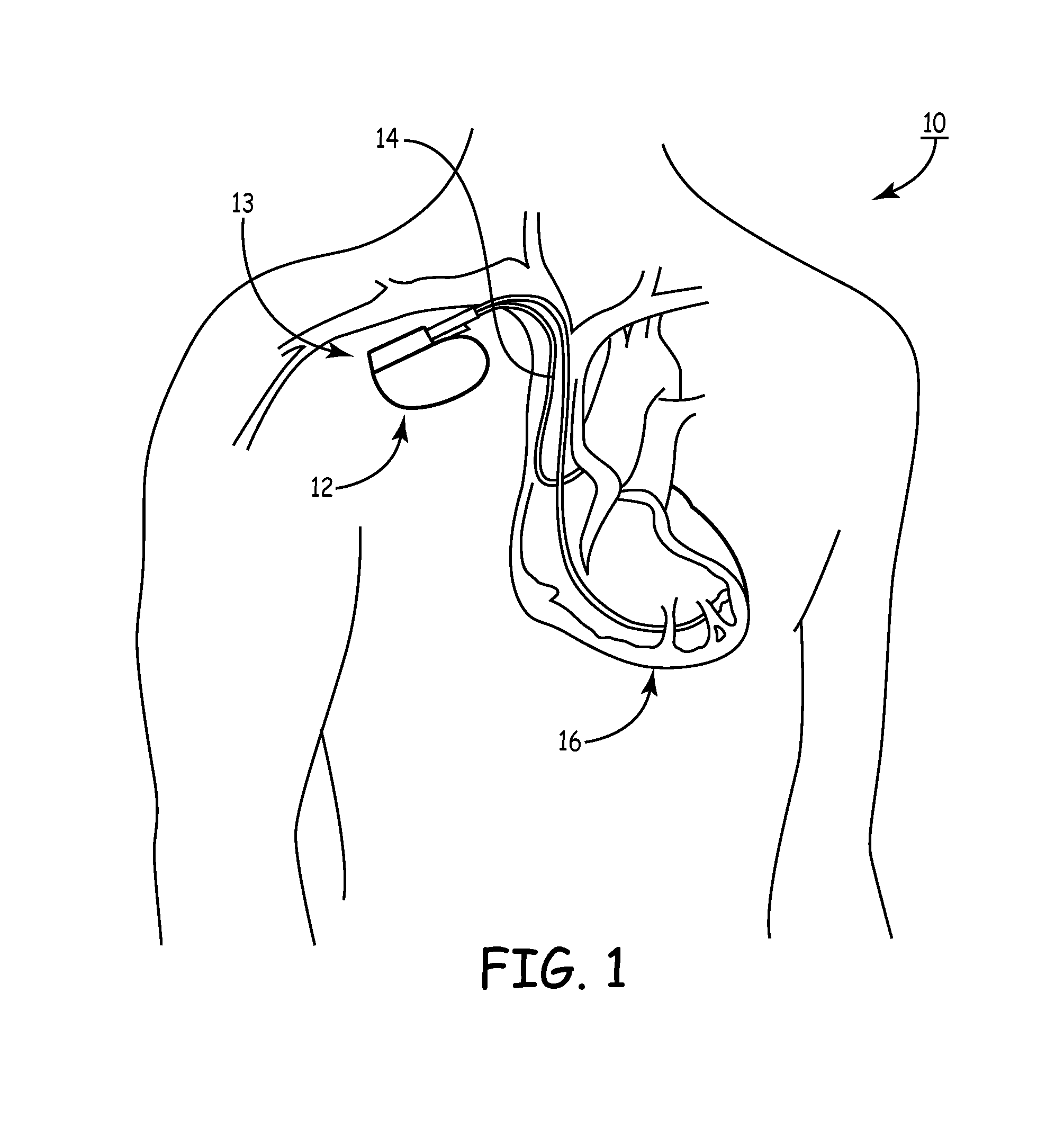 Resonance tuning module for implantable devices and leads