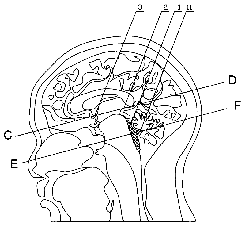 MRI positioning measurement method of anteroposterior diameter and left-right diameter of ventriculus quartus cerebri of human bodies