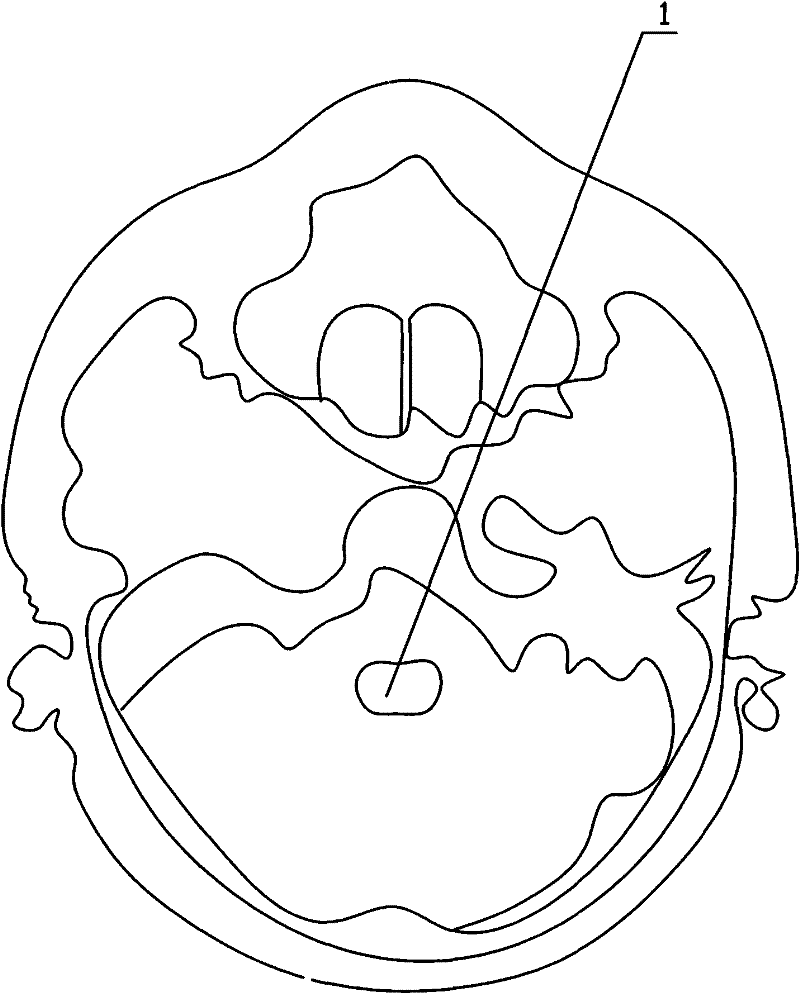 MRI positioning measurement method of anteroposterior diameter and left-right diameter of ventriculus quartus cerebri of human bodies